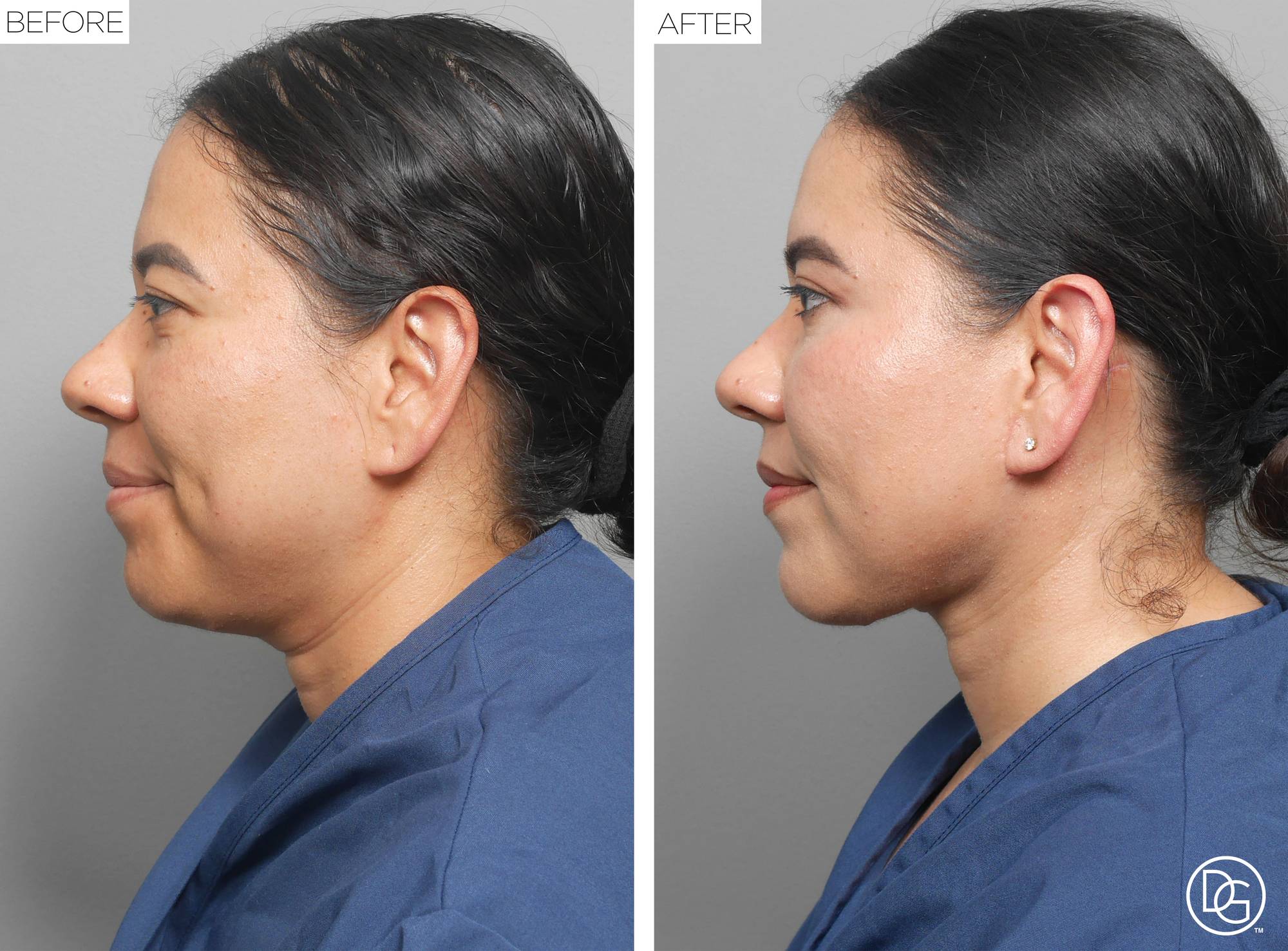 Weekend Lift Before & After Image