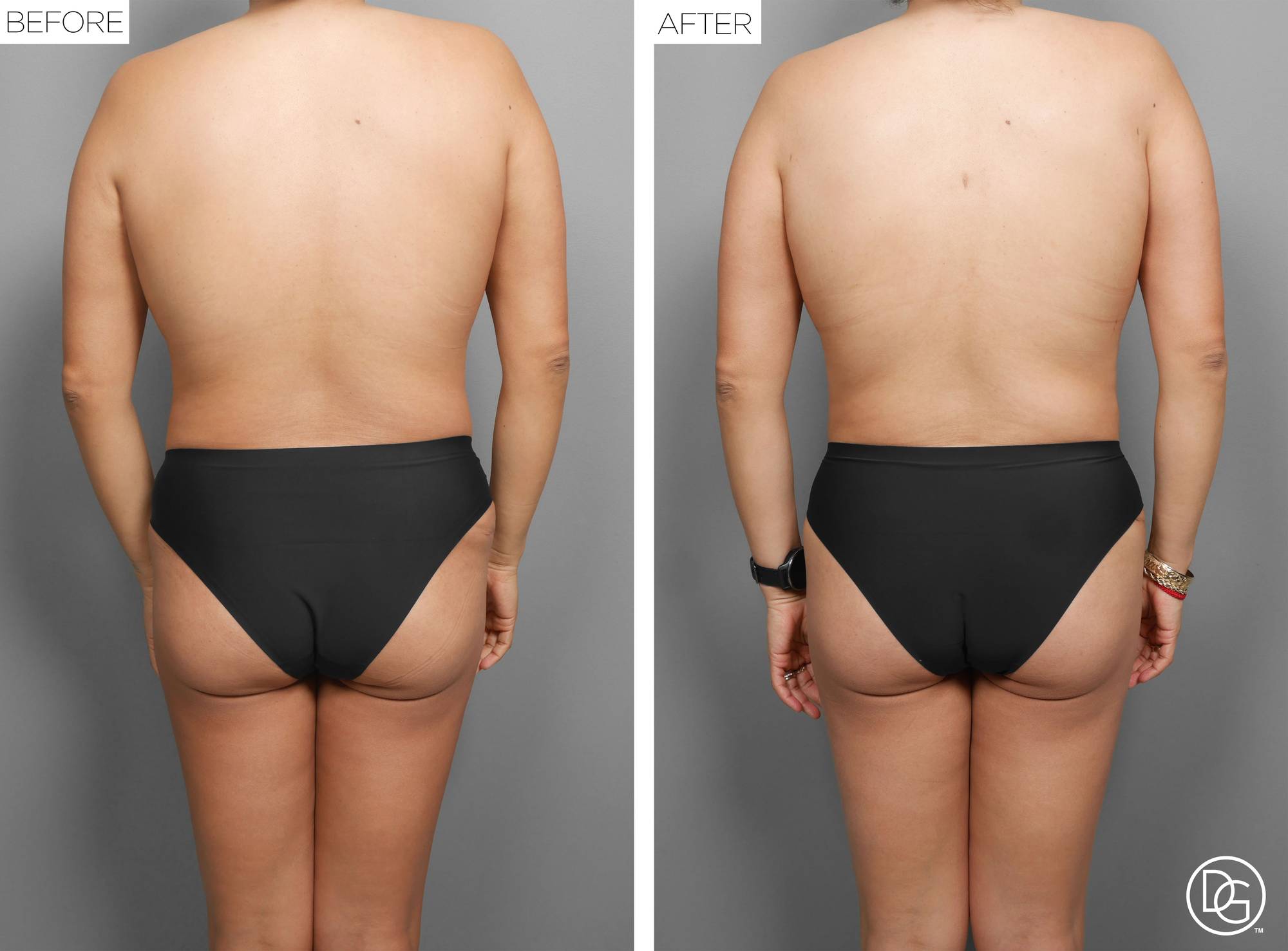 Liposuction Before & After Image