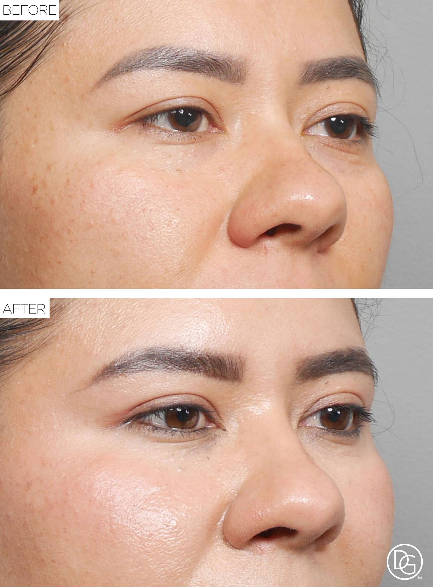 Blepharoplasty Before & After Image