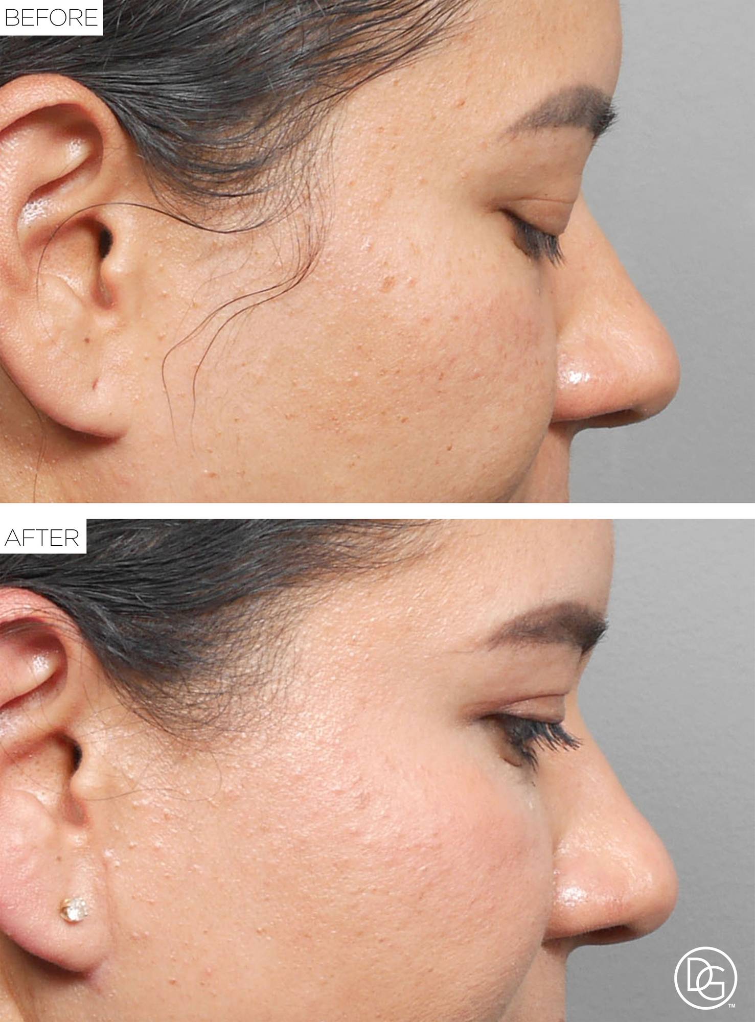 Blepharoplasty Before & After Image