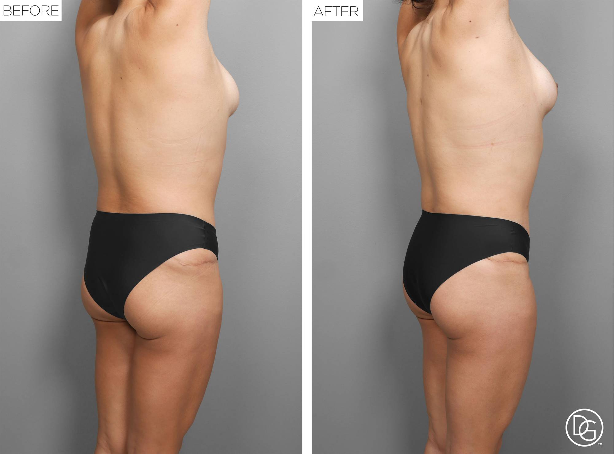 Liposuction Before & After Image