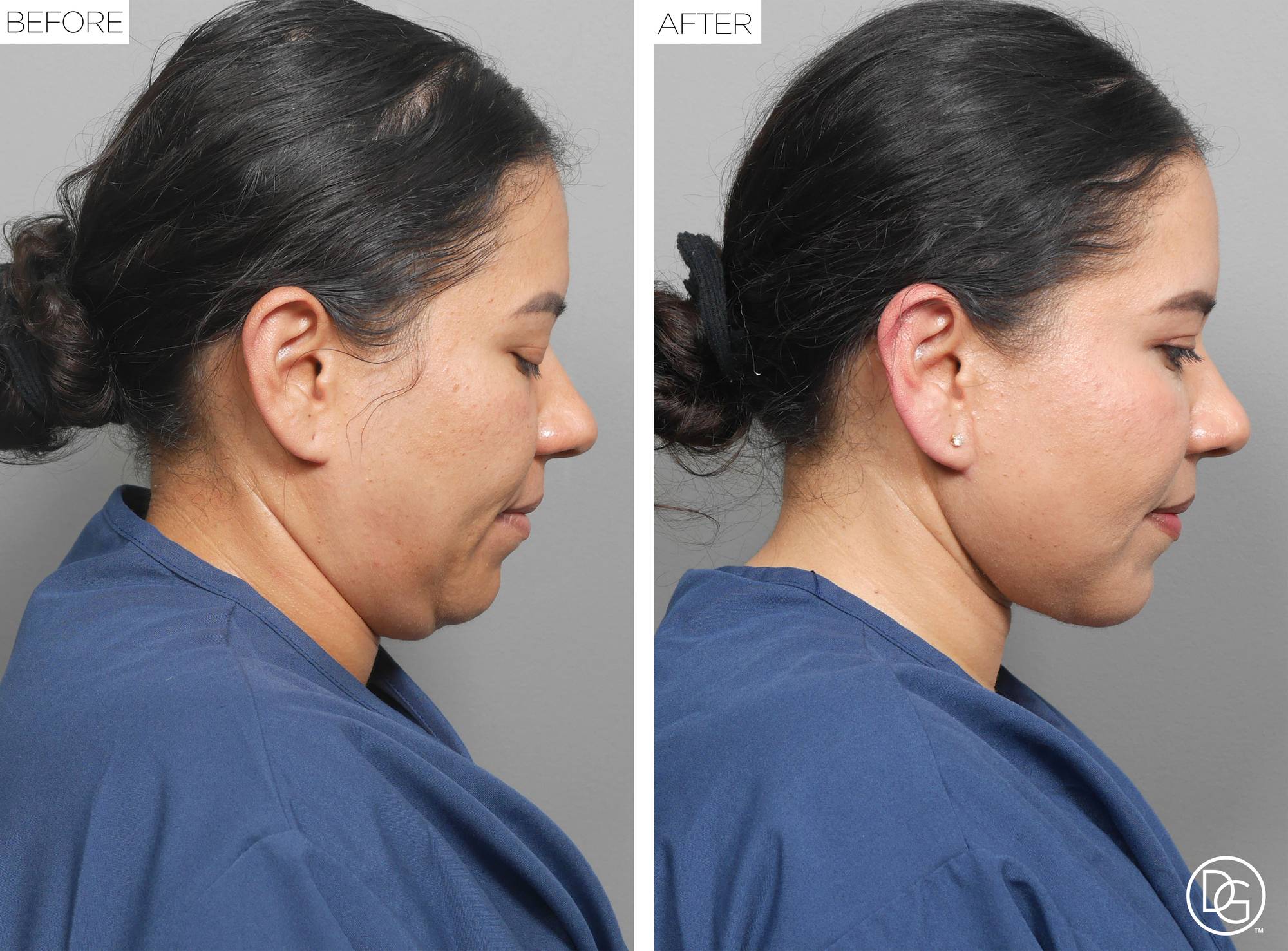 Weekend Lift Before & After Image