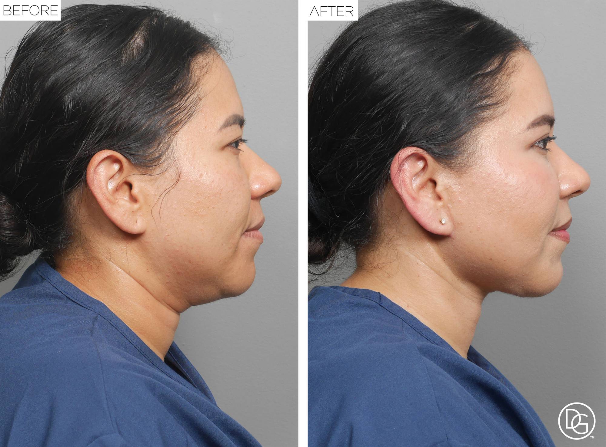 Weekend Lift Before & After Image