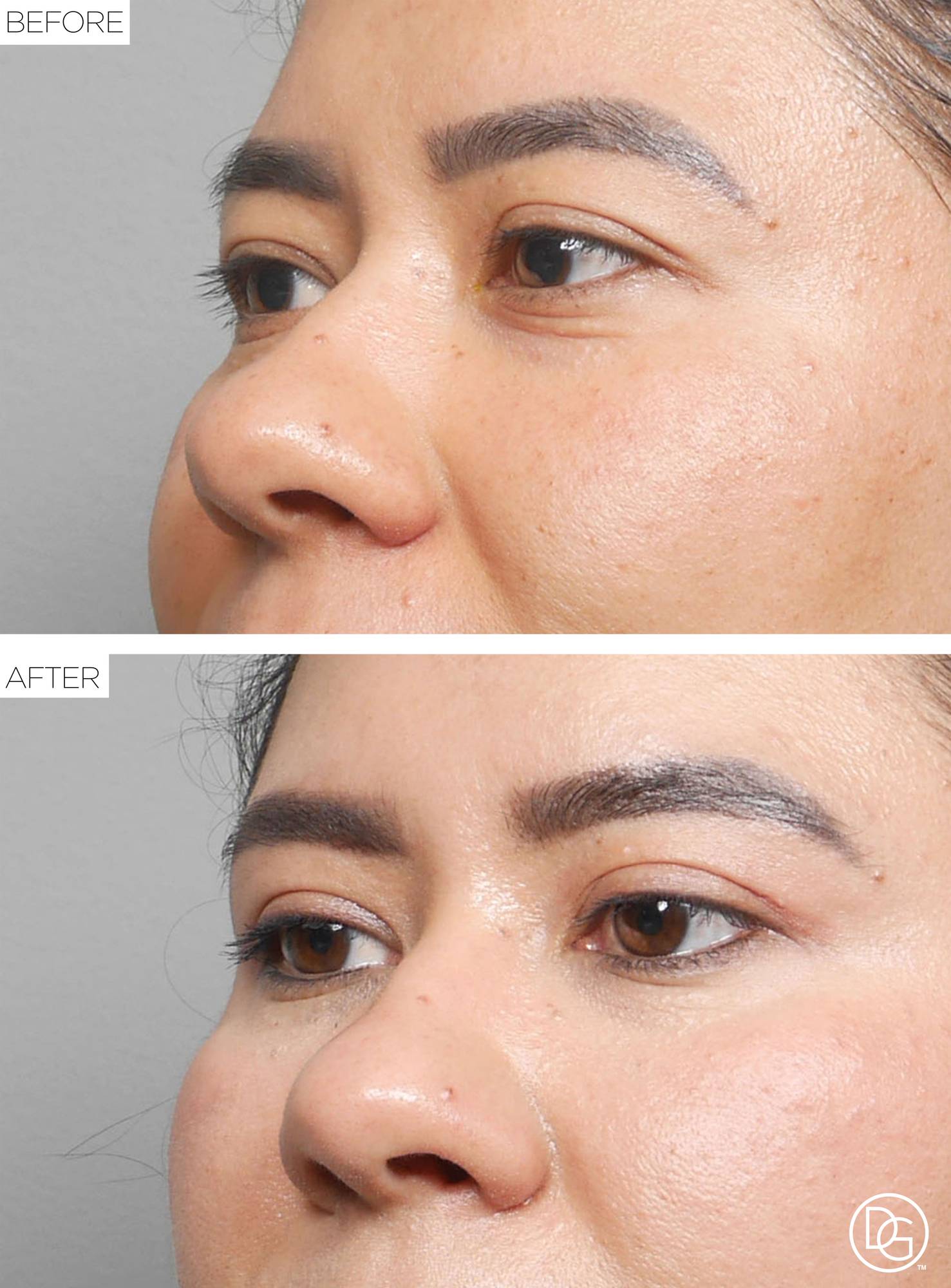 Blepharoplasty Before & After Image