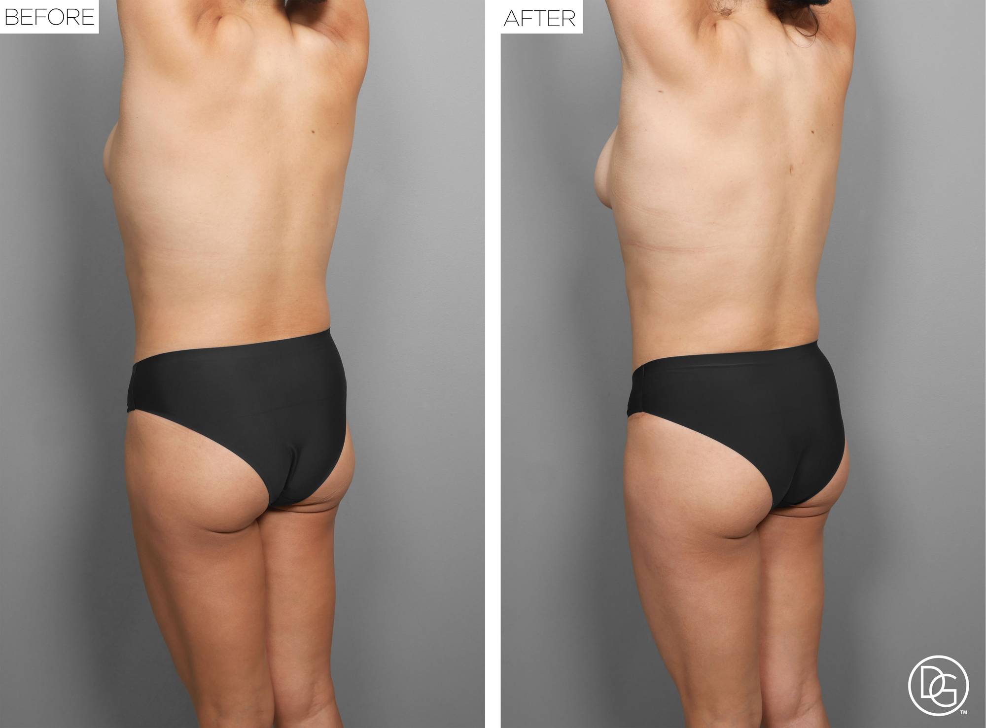 Liposuction Before & After Image