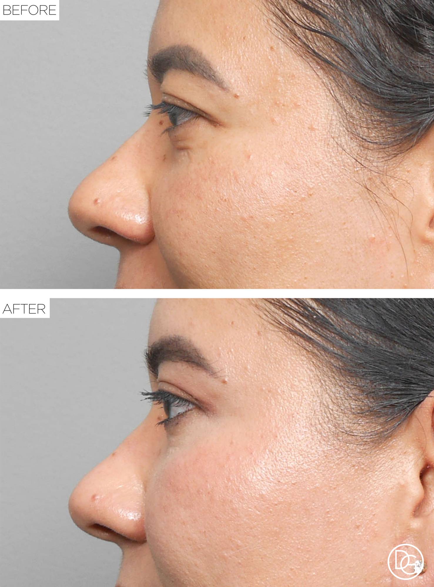 Blepharoplasty Before & After Image