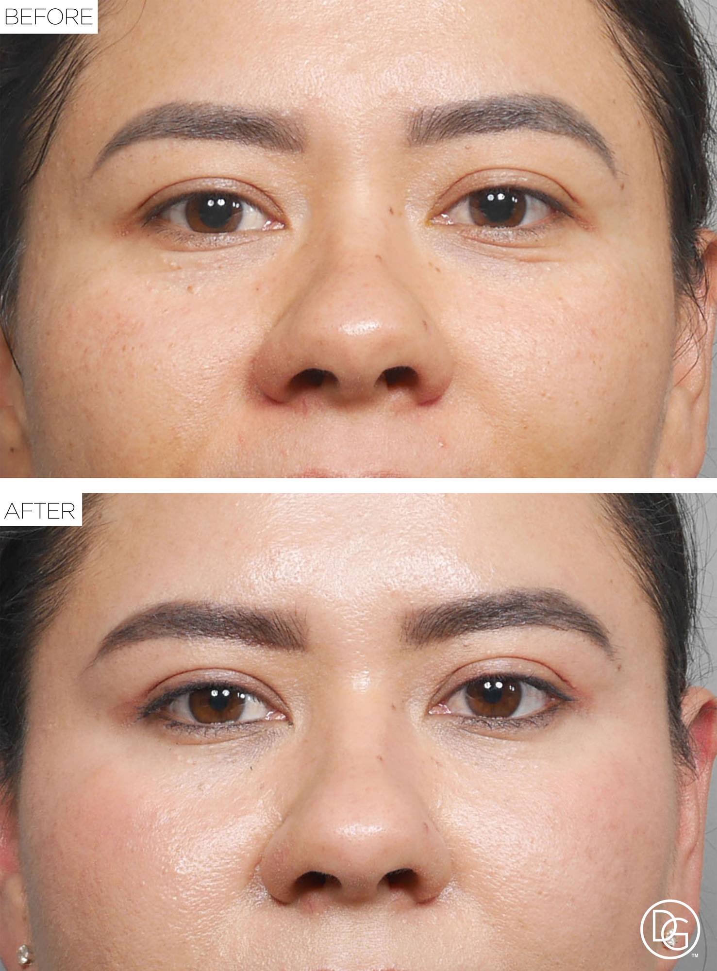Blepharoplasty Before & After Image
