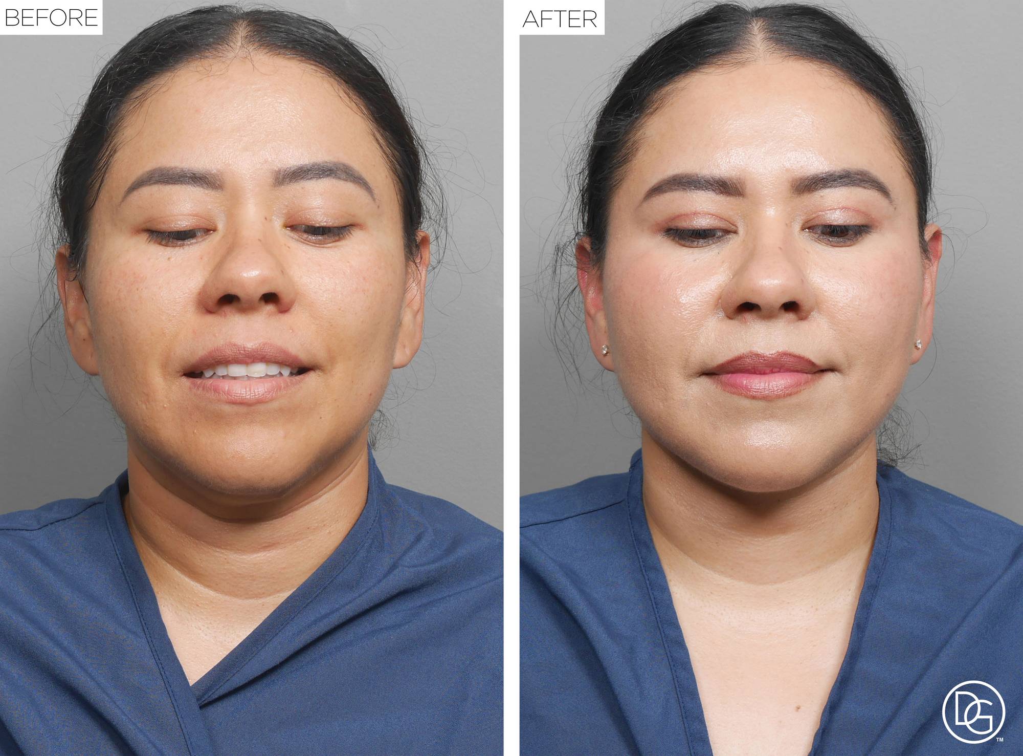 Weekend Lift Before & After Image