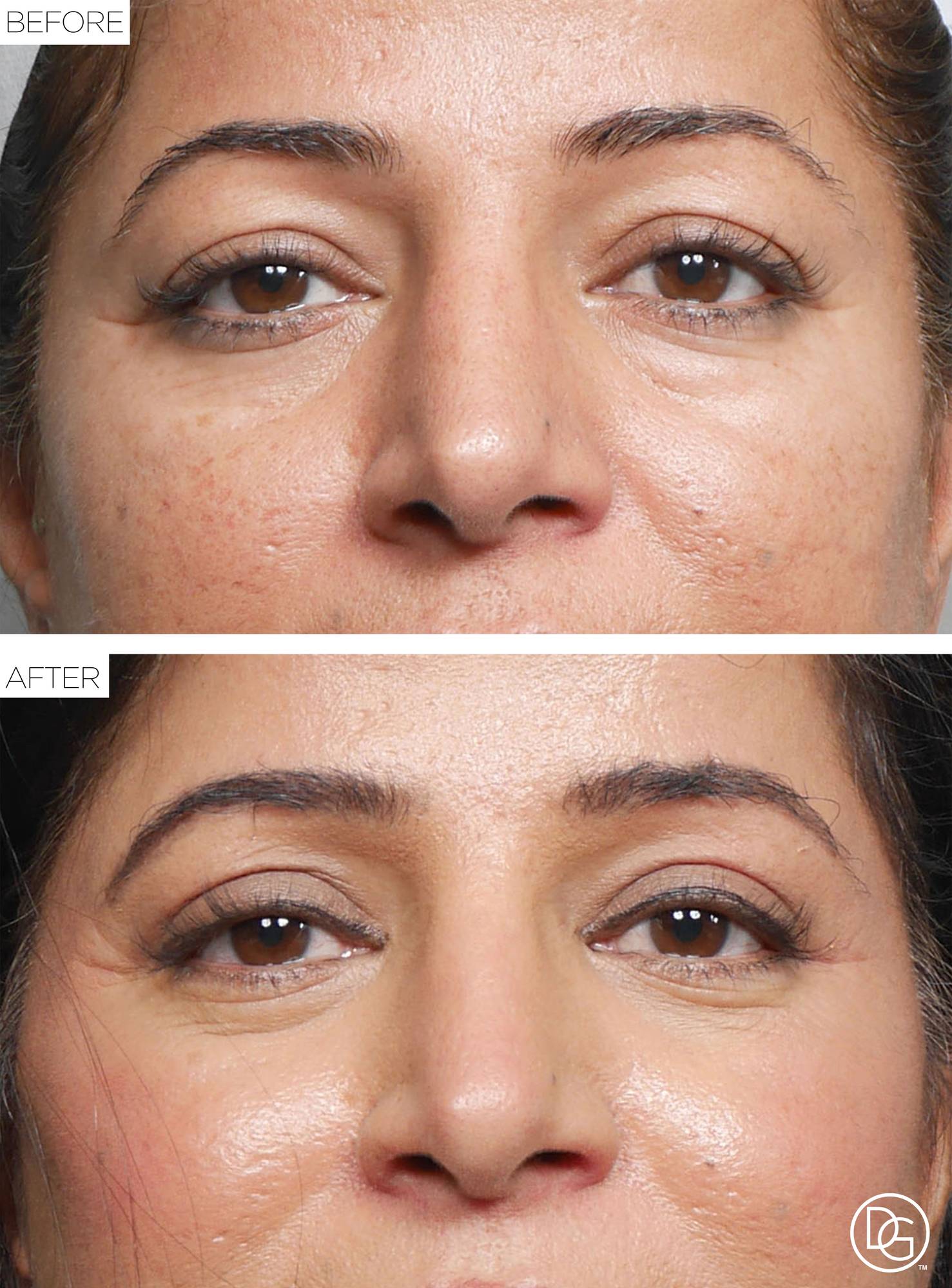 Blepharoplasty Before & After Image