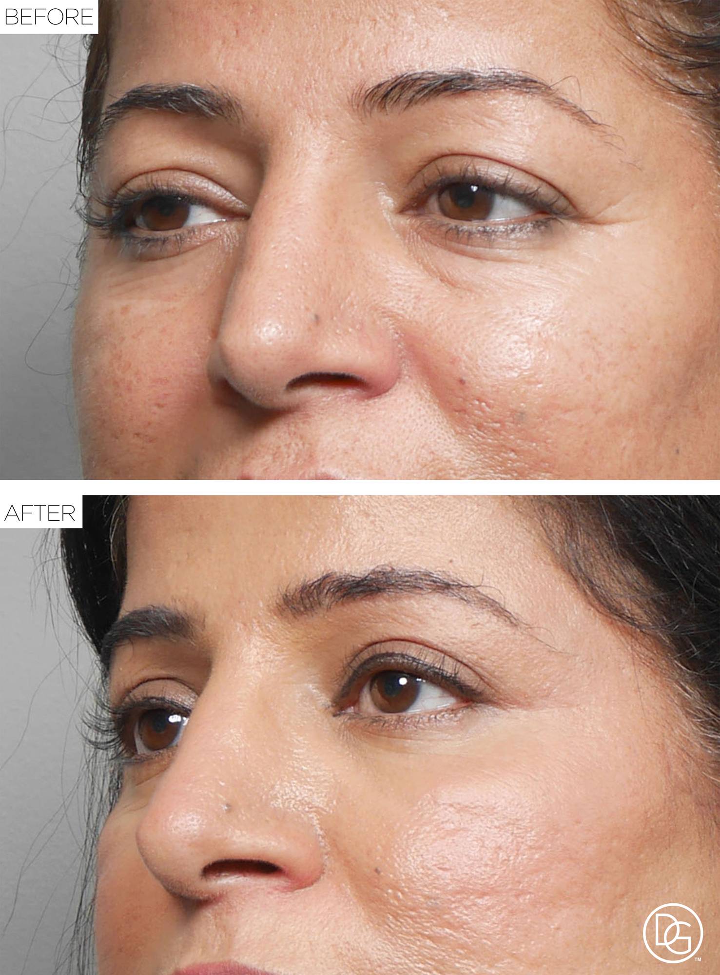 Blepharoplasty Before & After Image