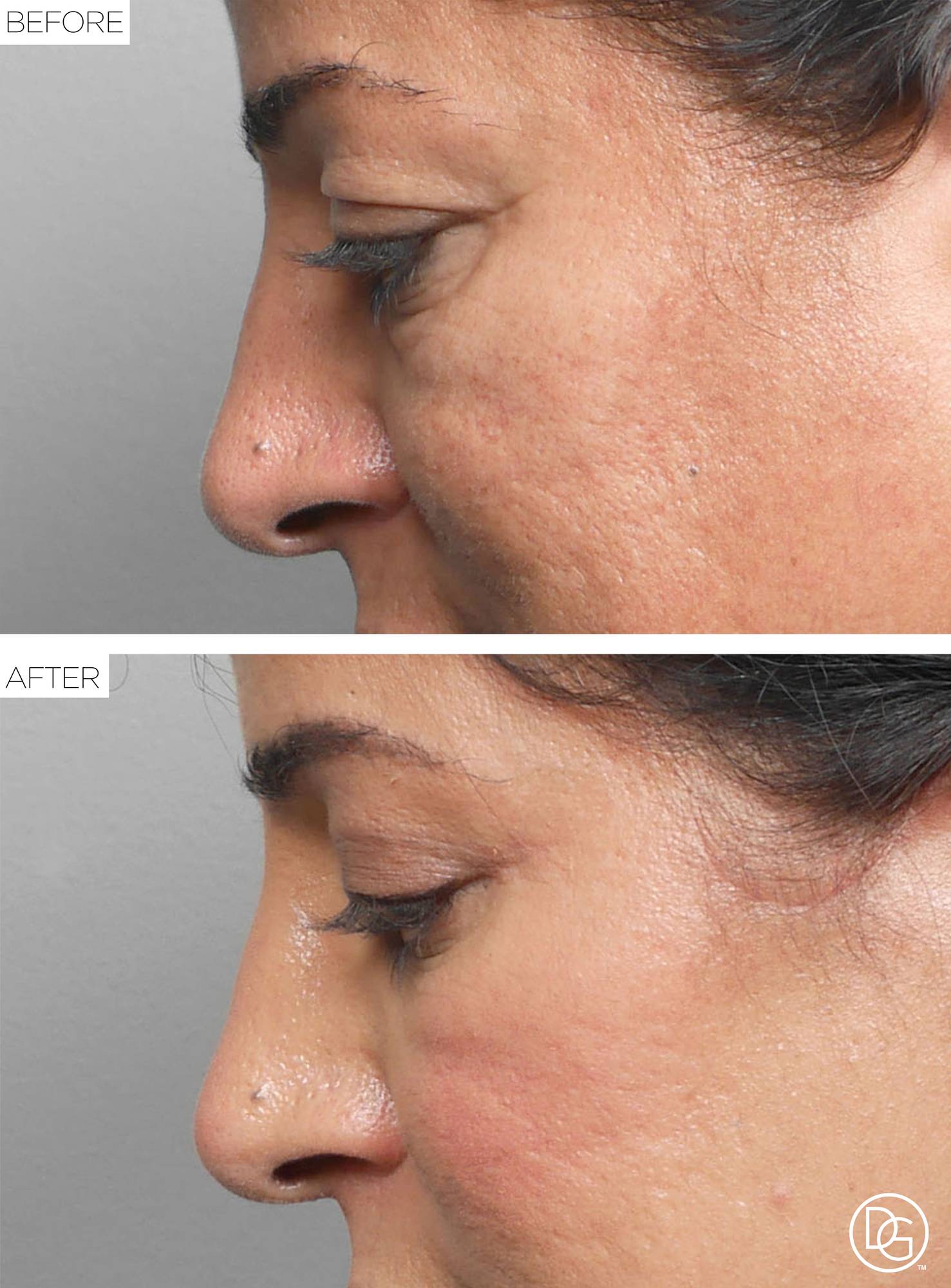 Blepharoplasty Before & After Image