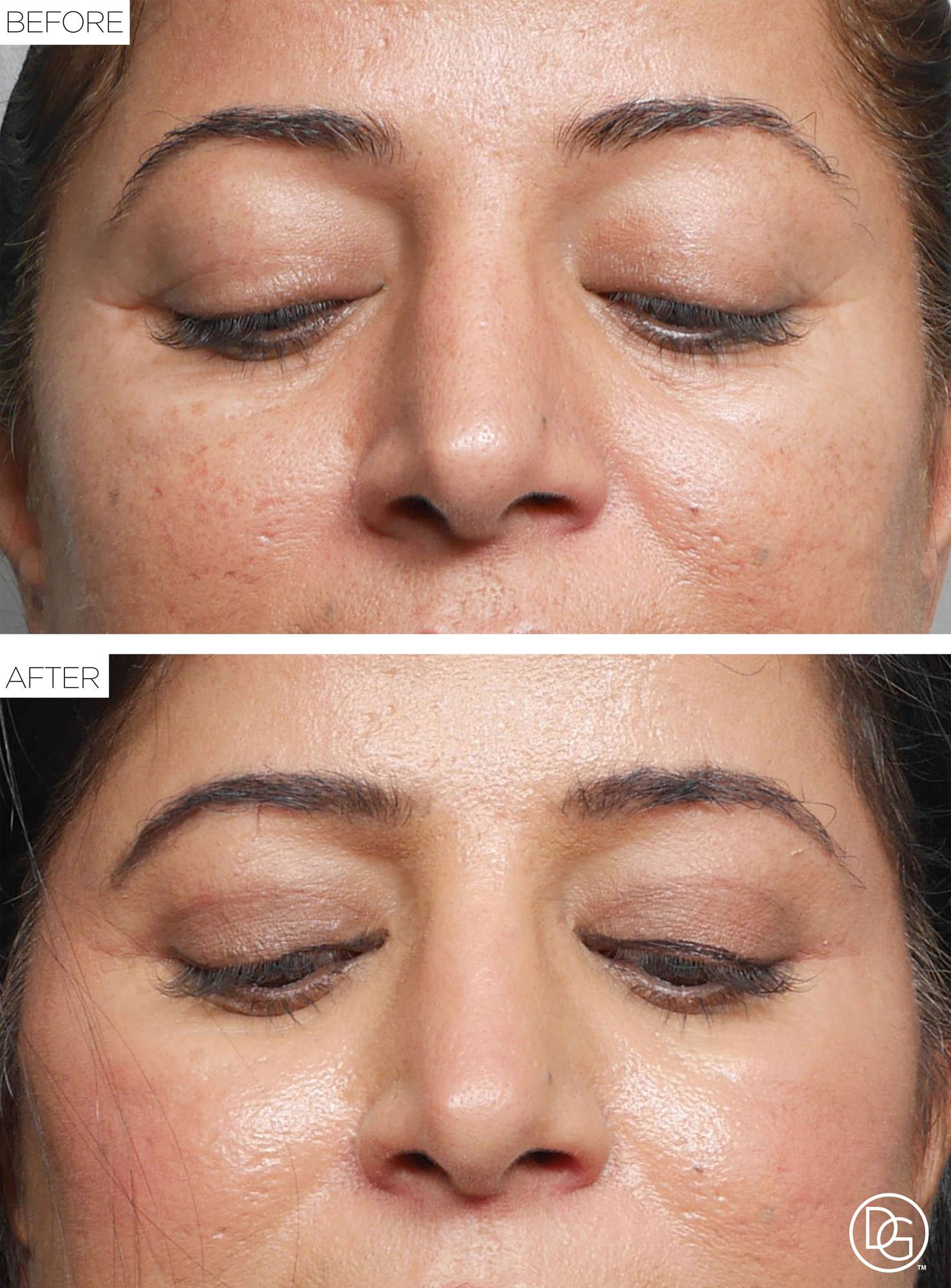 Blepharoplasty Before & After Image