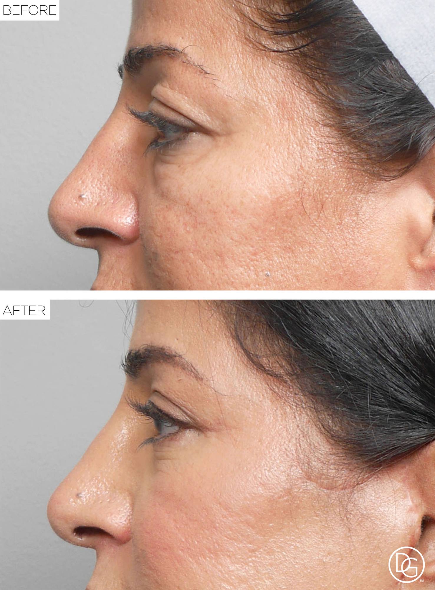 Blepharoplasty Before & After Image