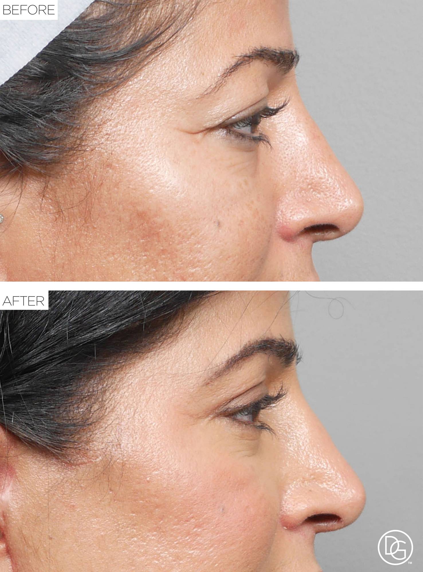 Blepharoplasty Before & After Image