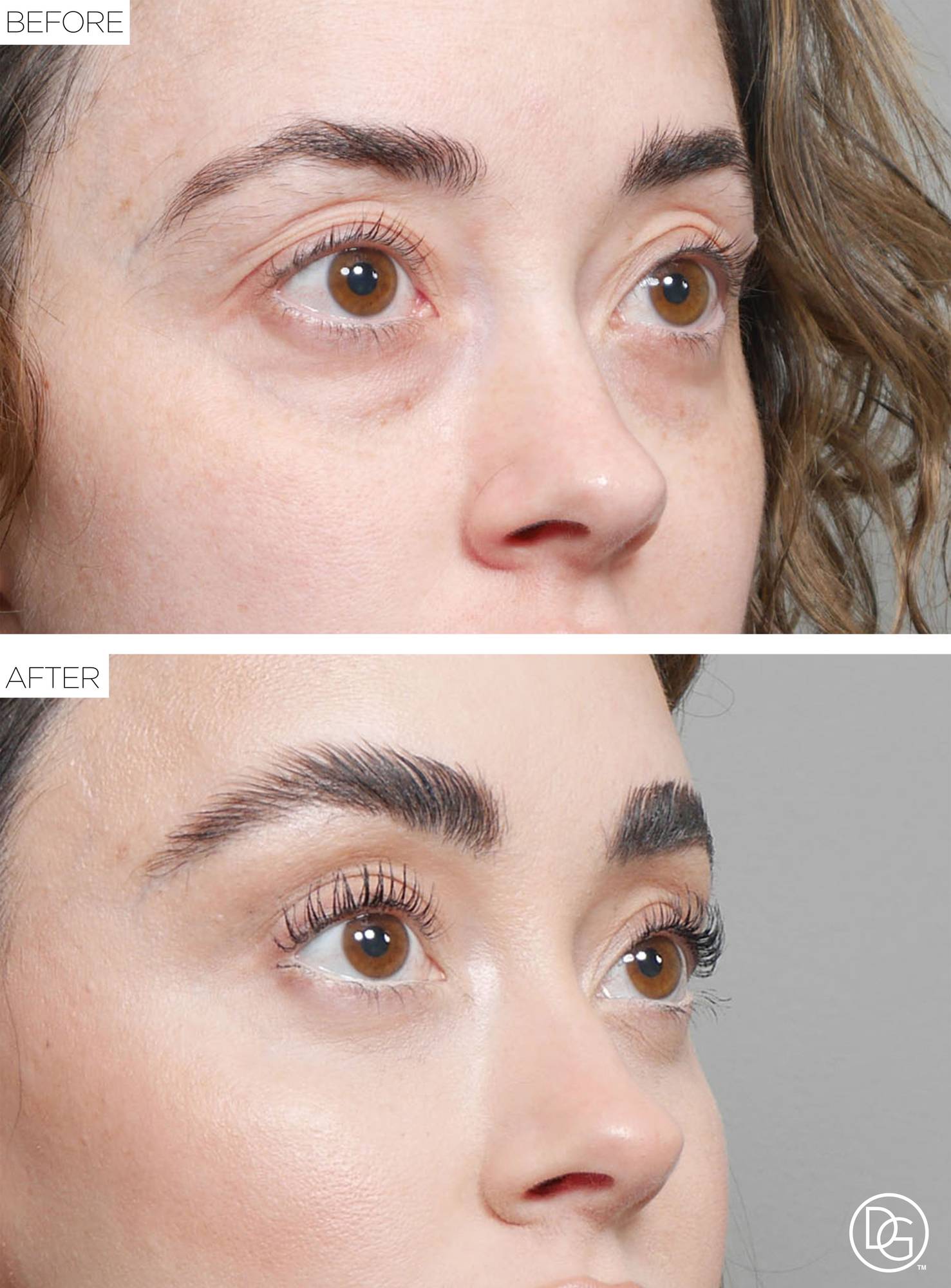 Brow Lift Before & After Image