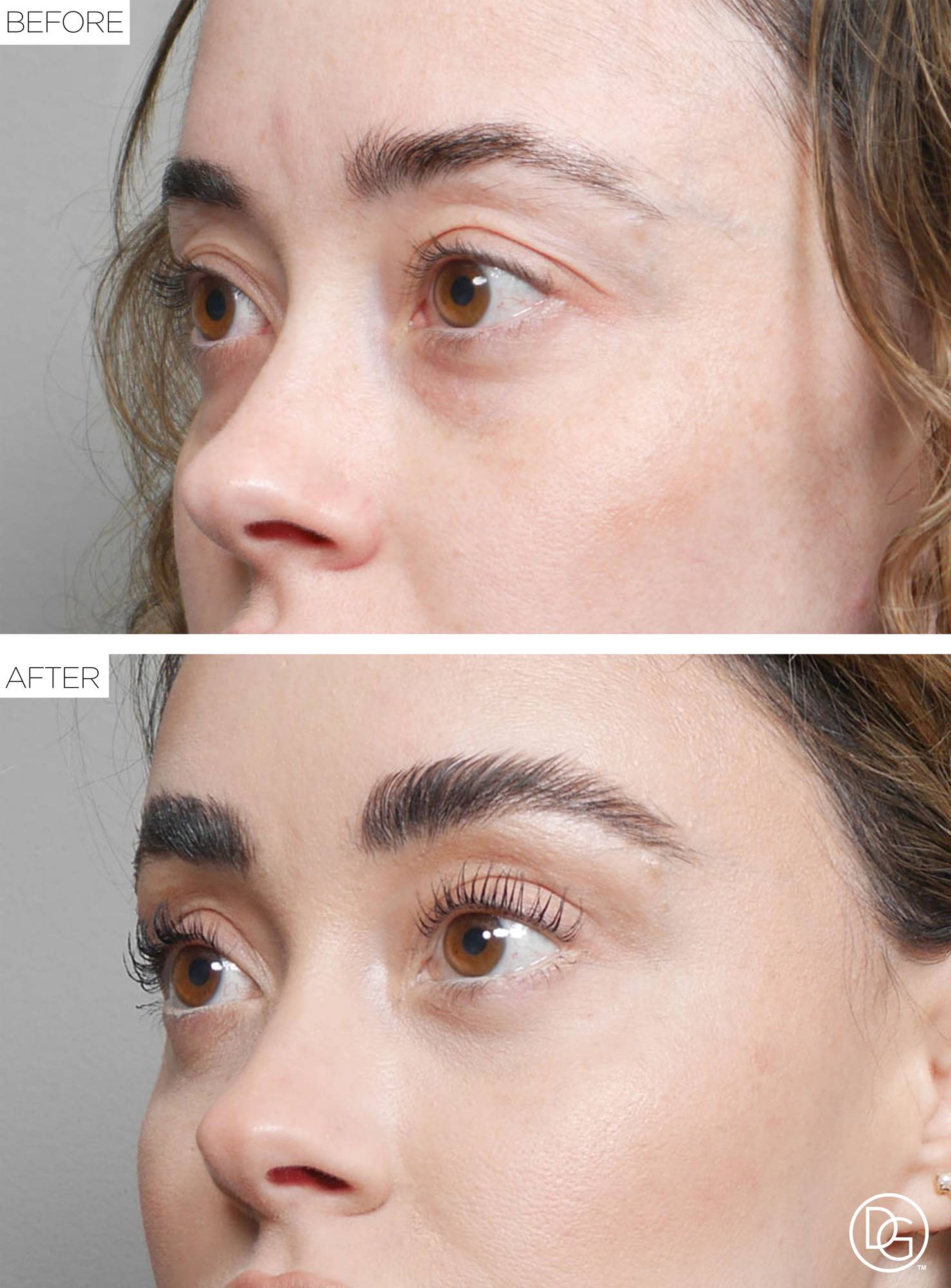 Brow Lift Before & After Image