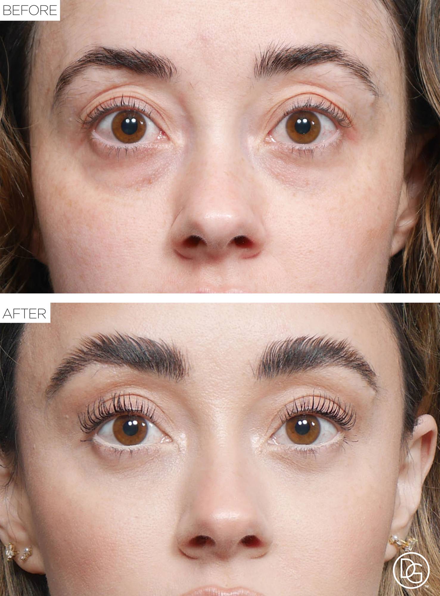Brow Lift Before & After Image