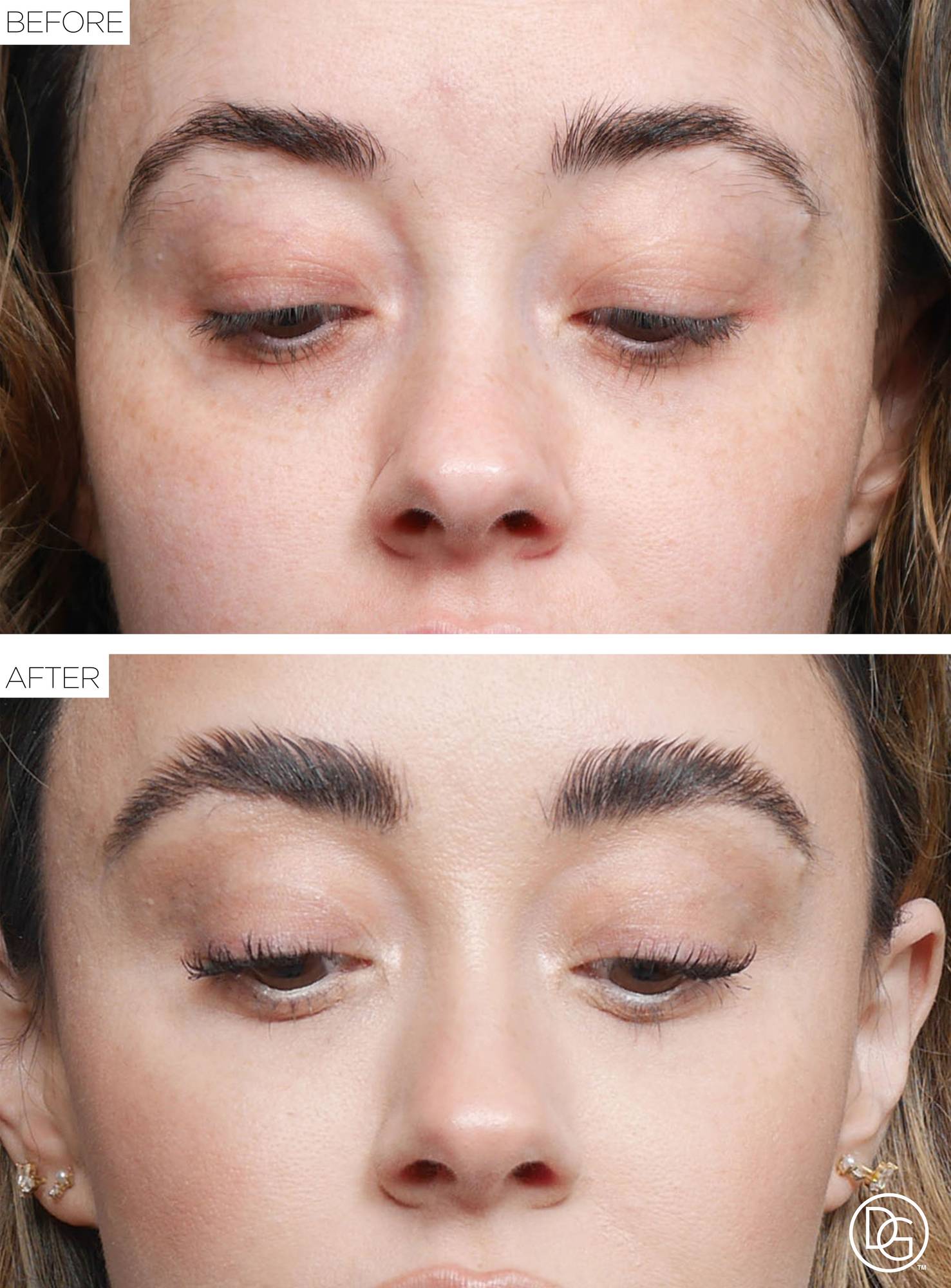 Brow Lift Before & After Image