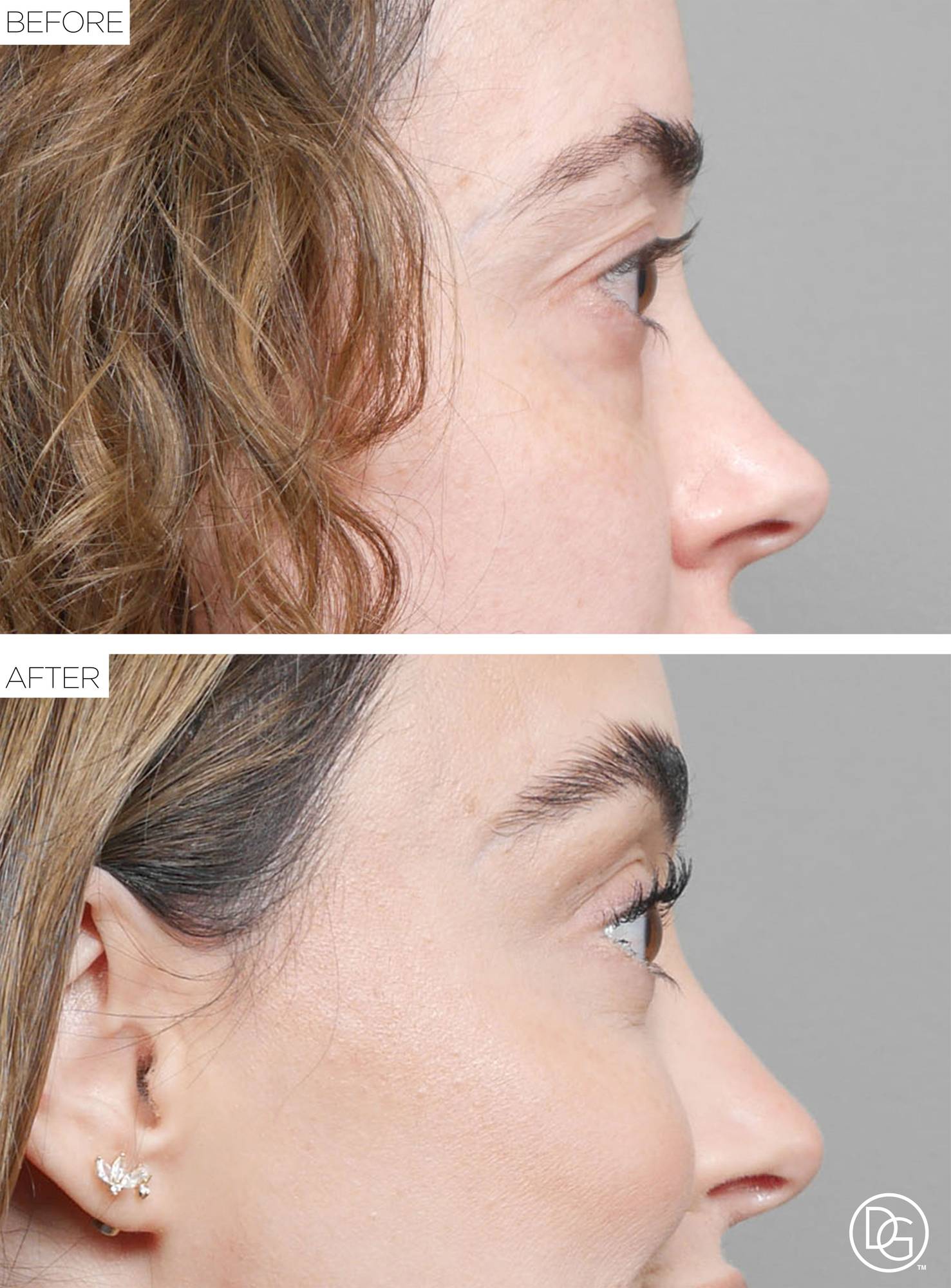 Brow Lift Before & After Image