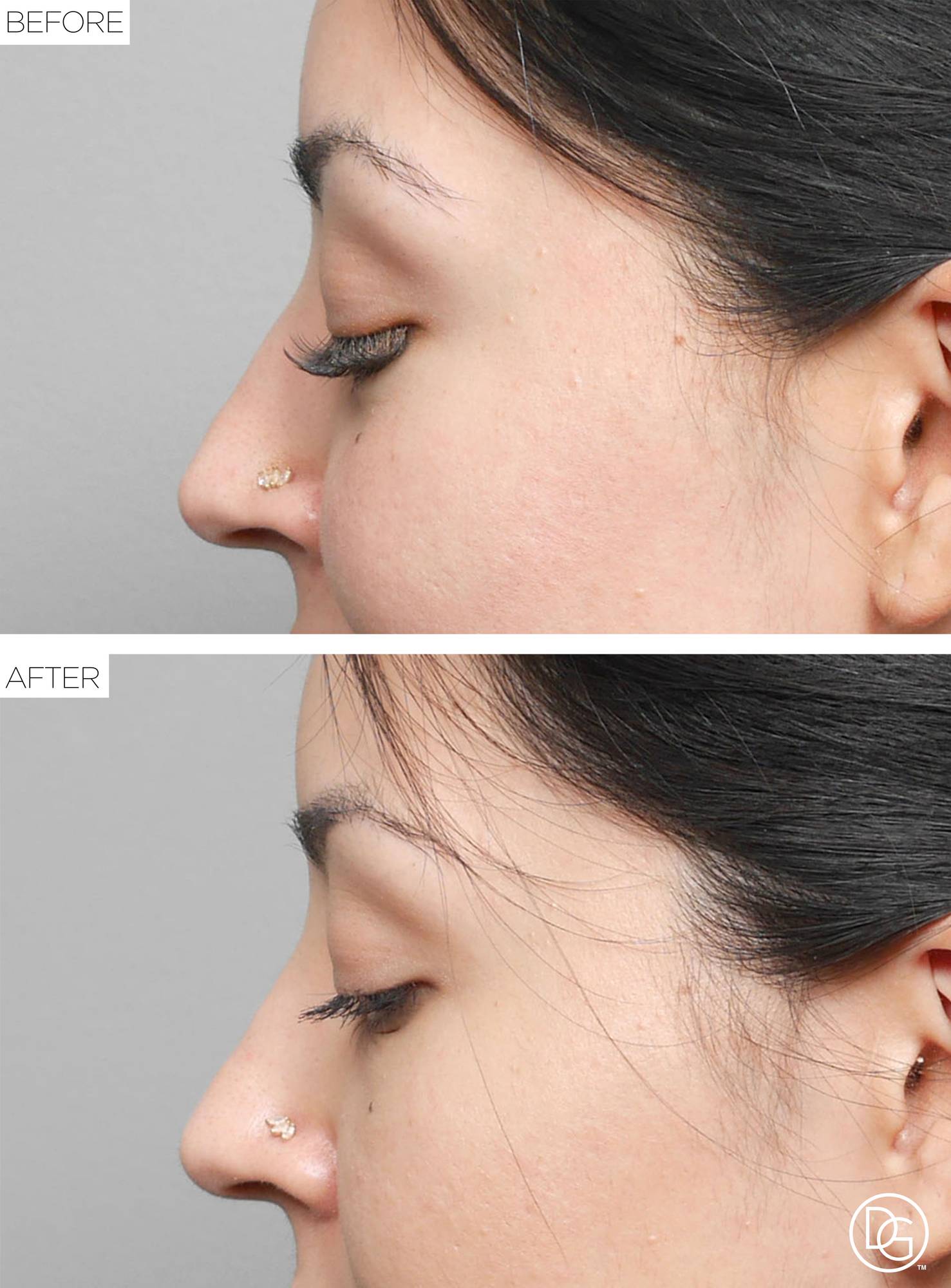 Blepharoplasty Before & After Image
