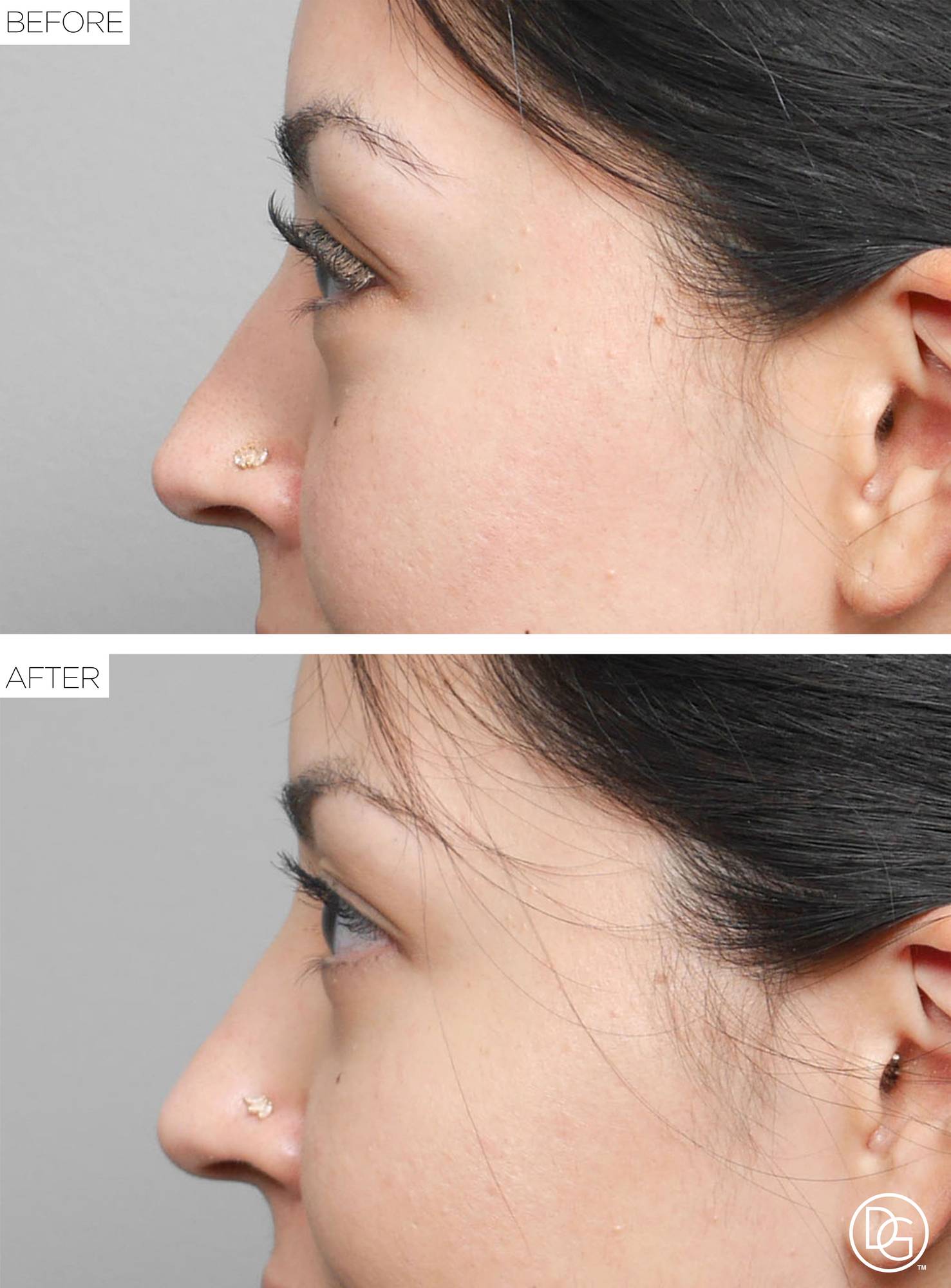 Blepharoplasty Before & After Image