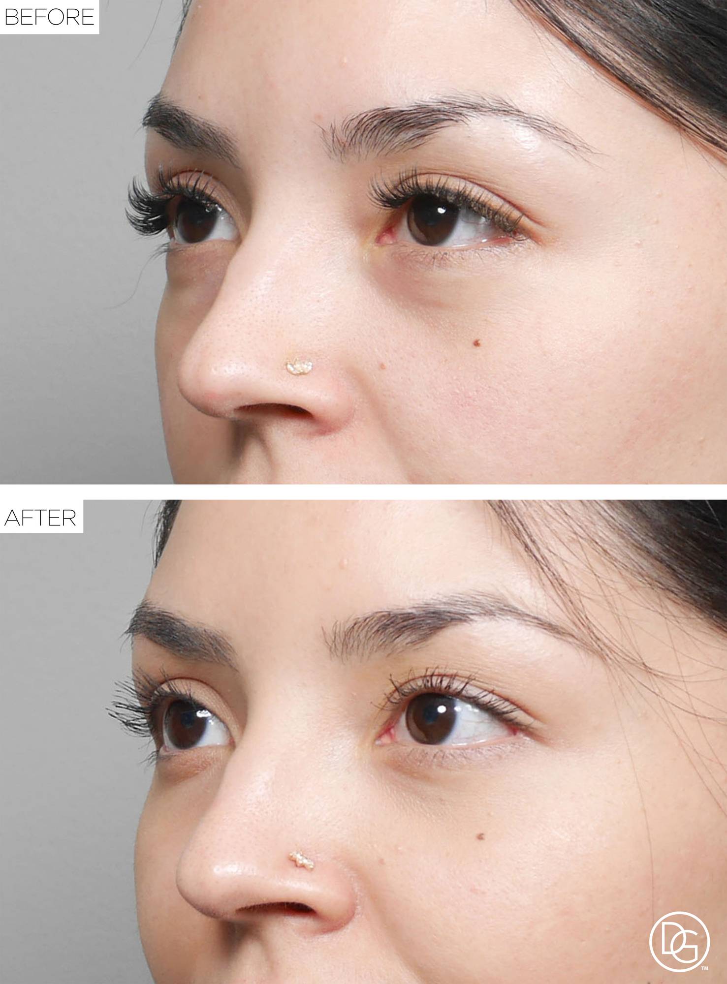 Blepharoplasty Before & After Image