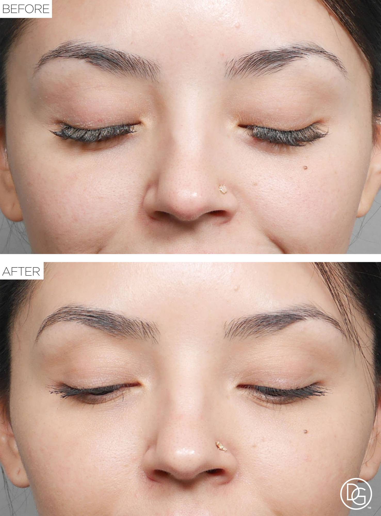 Blepharoplasty Before & After Image