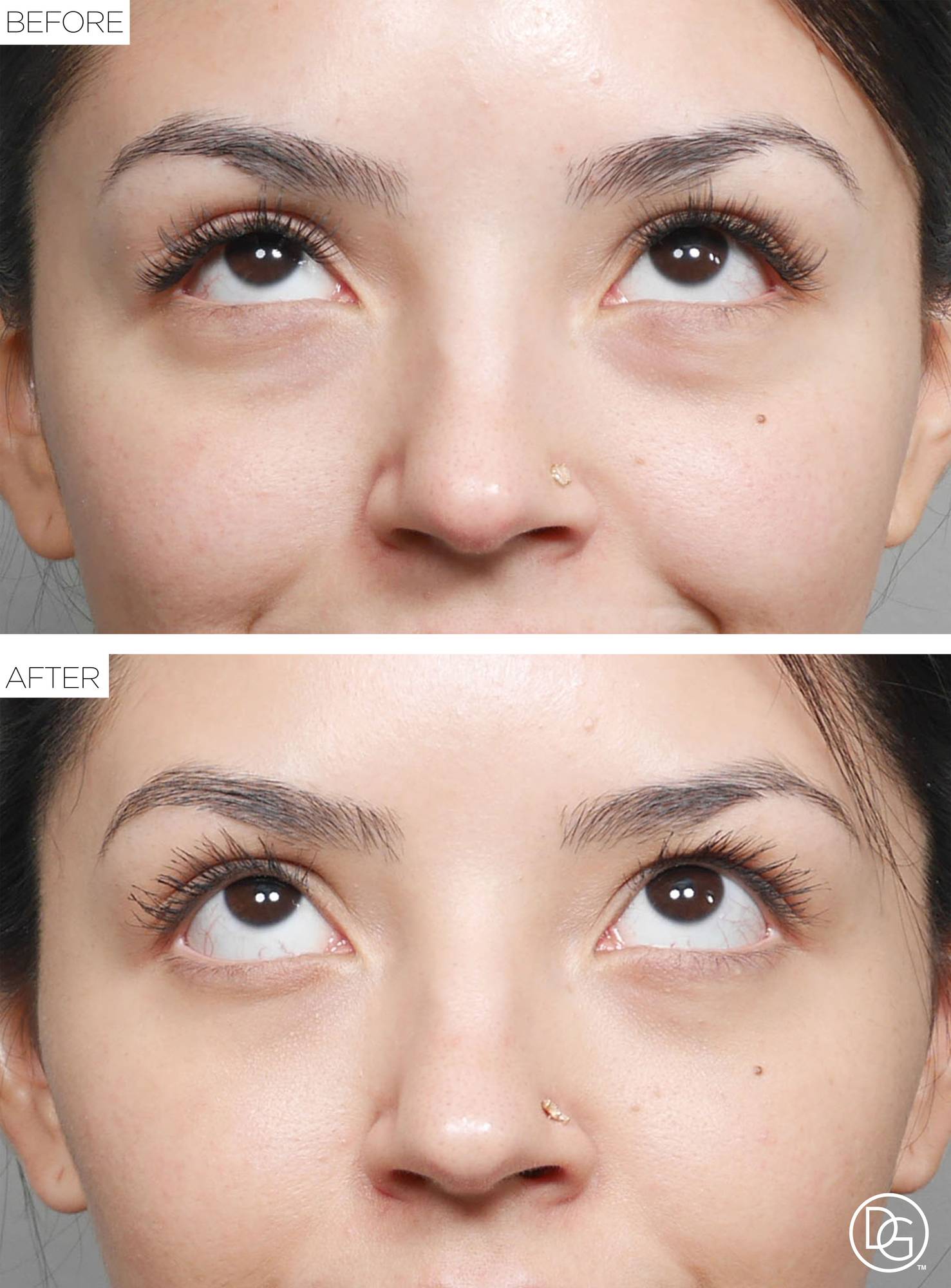 Blepharoplasty Before & After Image