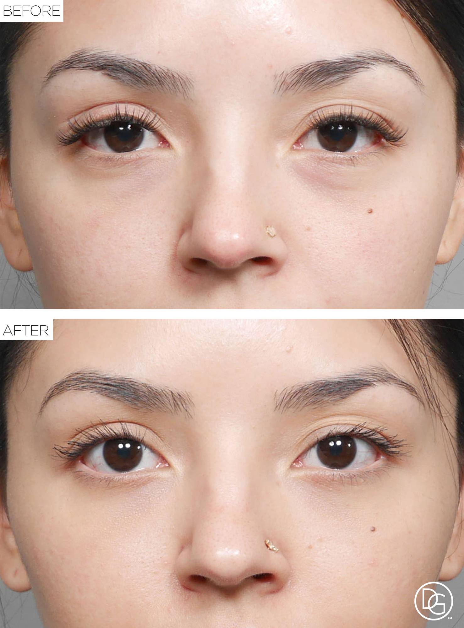 Blepharoplasty Before & After Image