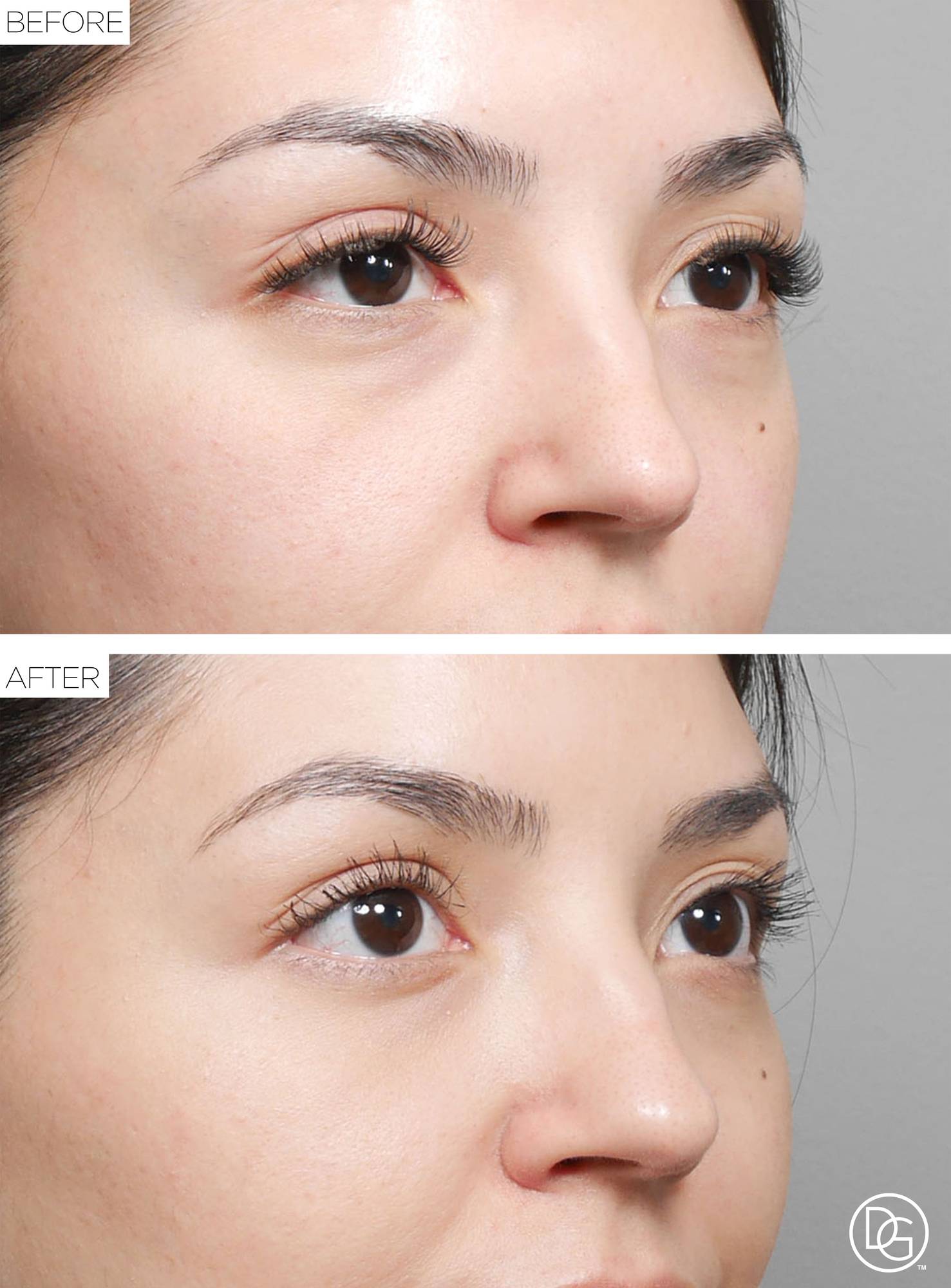 Blepharoplasty Before & After Image