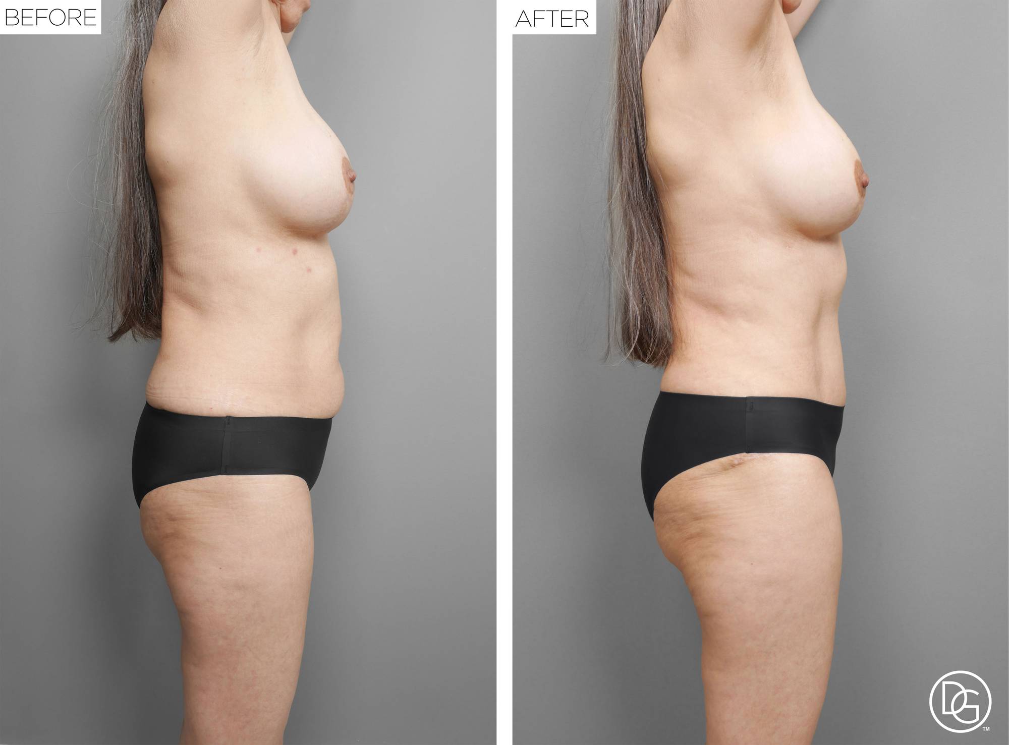  Tummy Tuck Before & After Image