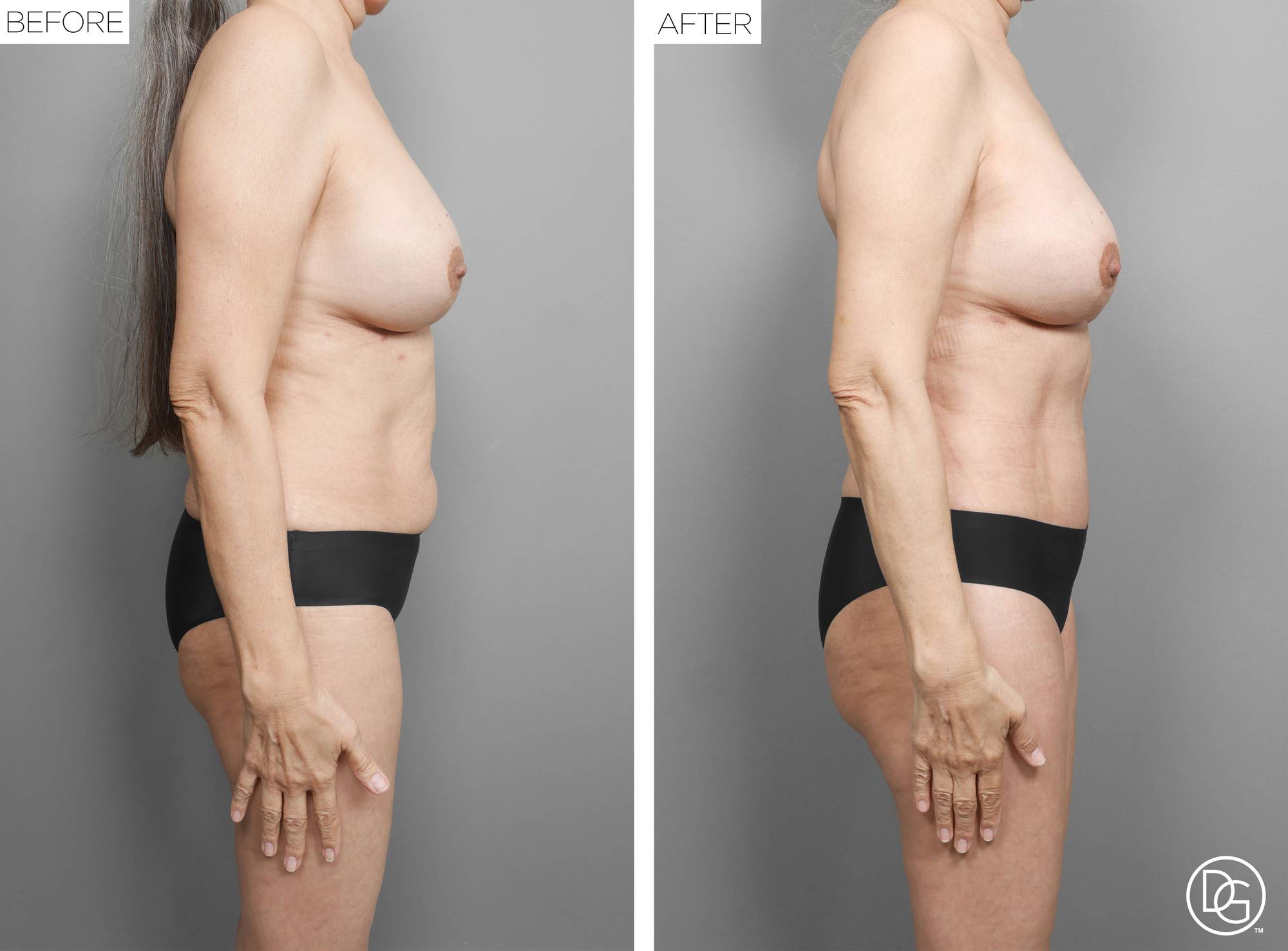  Tummy Tuck Before & After Image