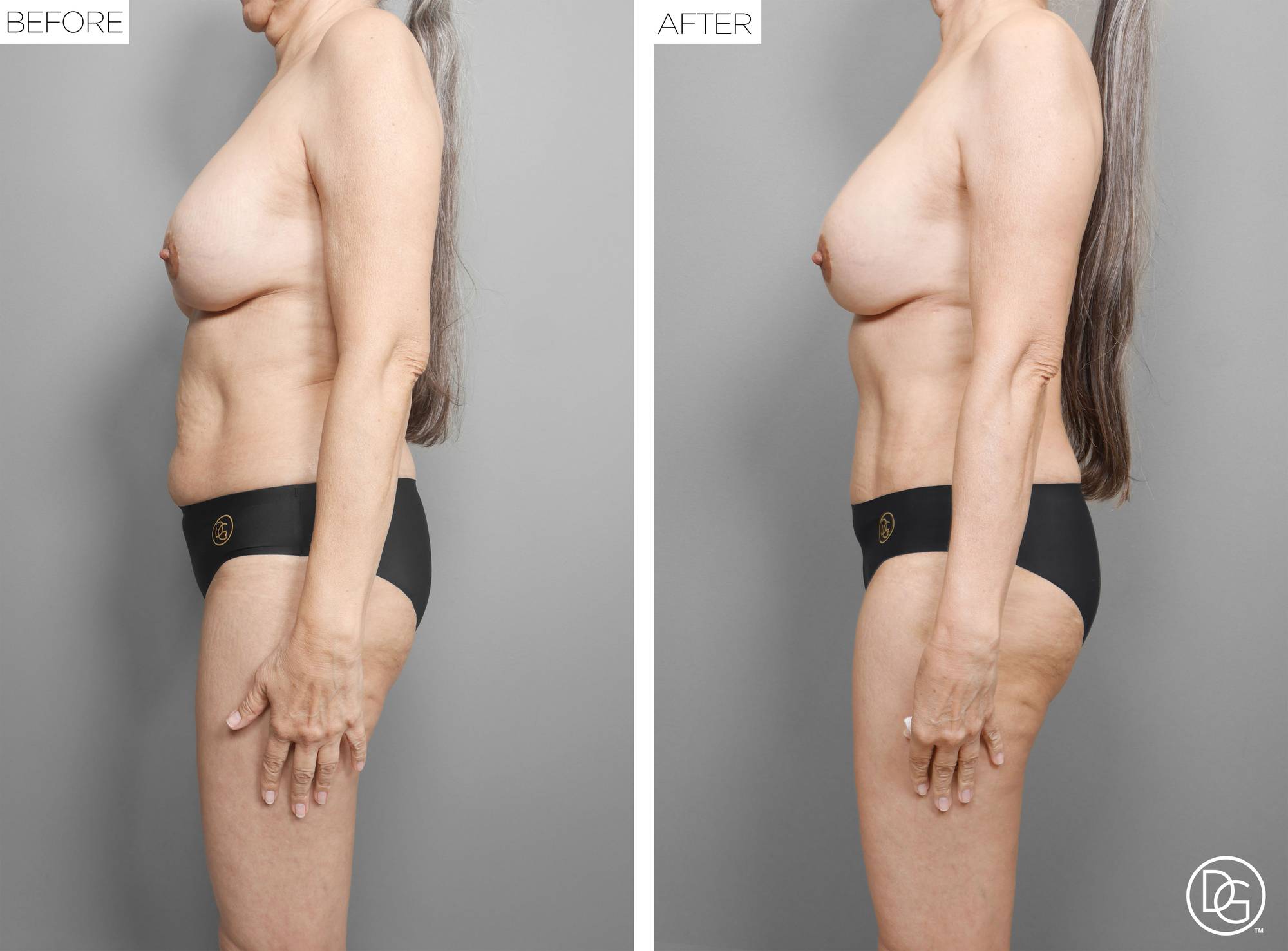  Tummy Tuck Before & After Image