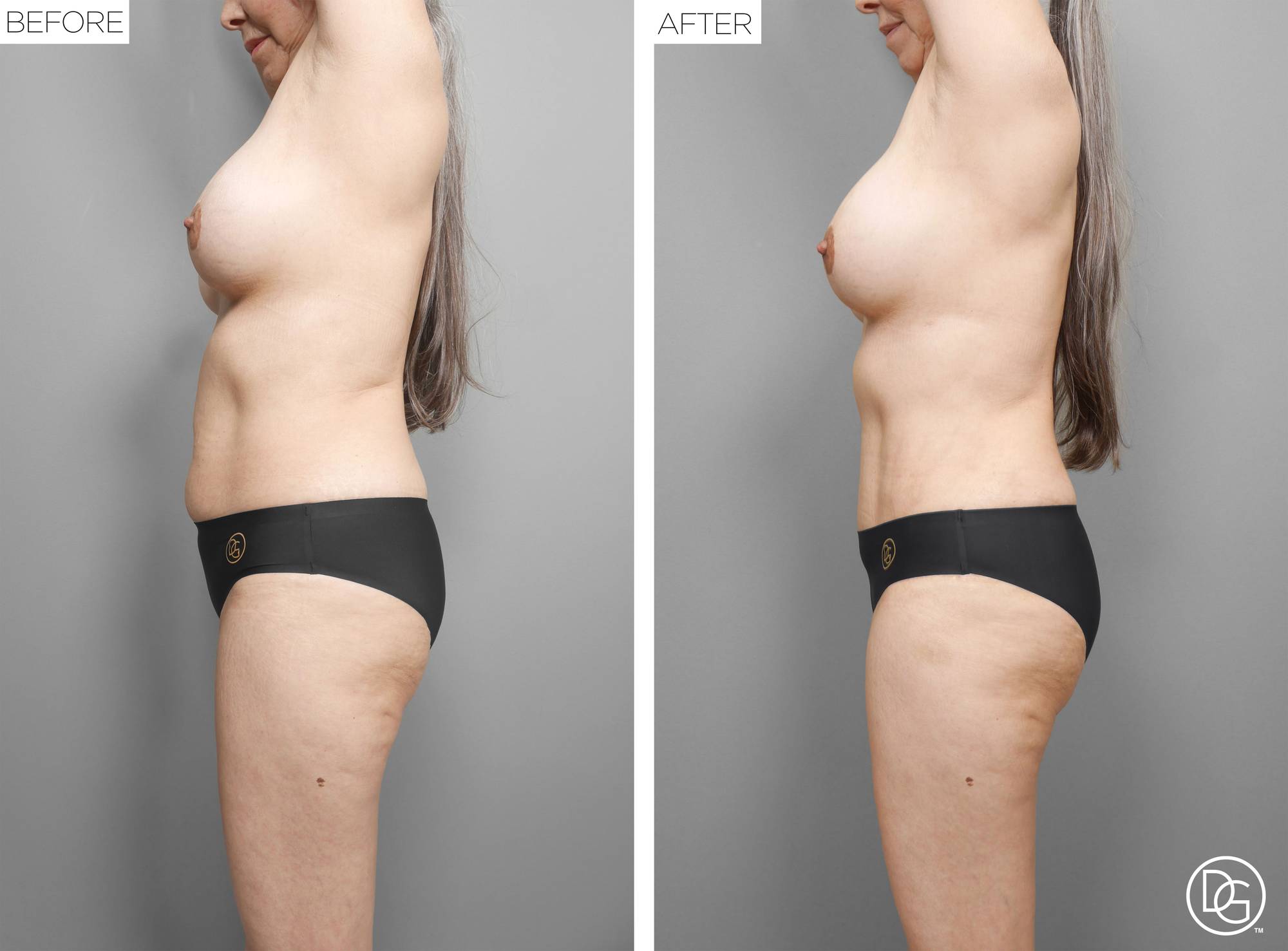  Tummy Tuck Before & After Image