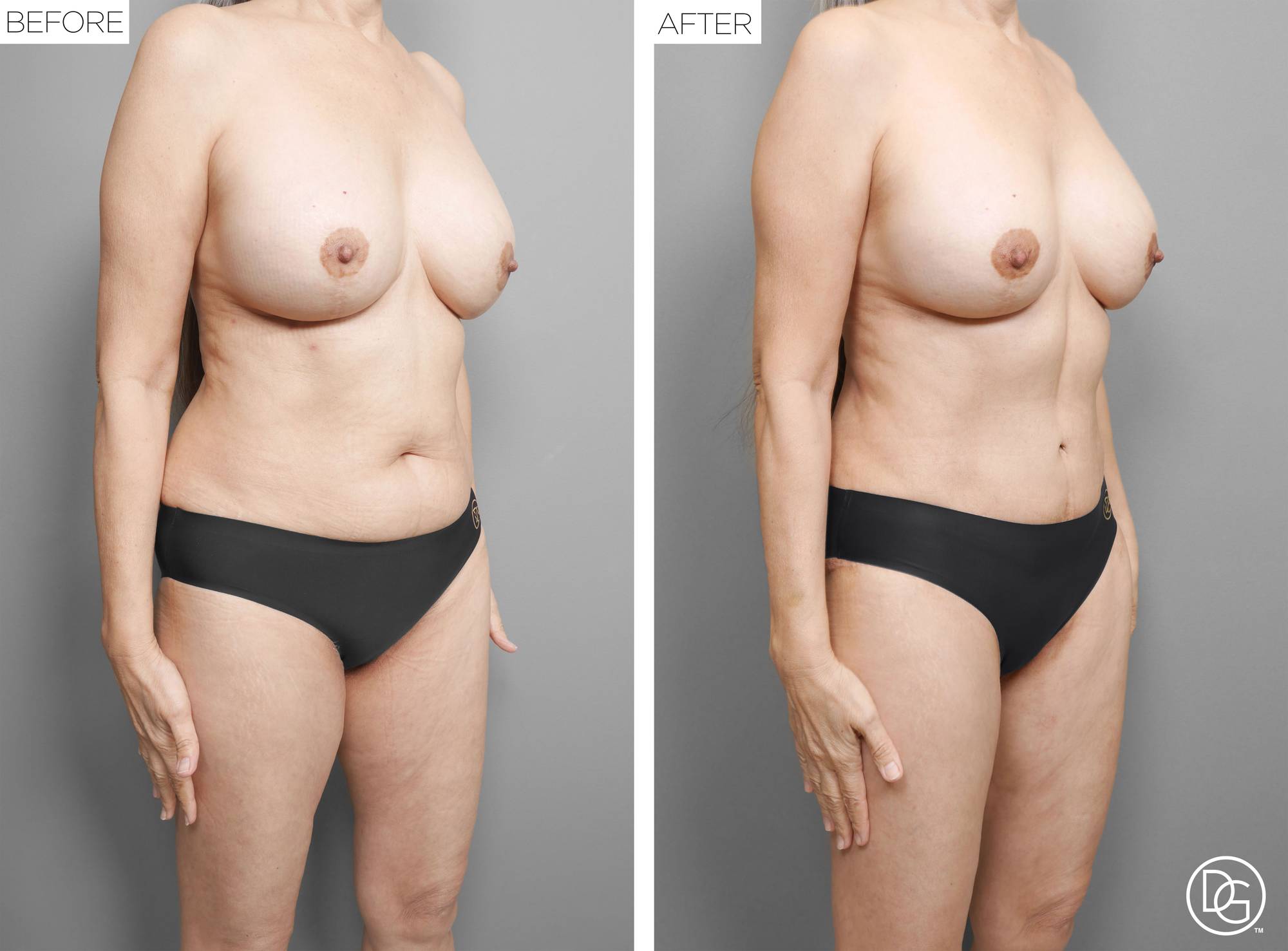  Tummy Tuck Before & After Image