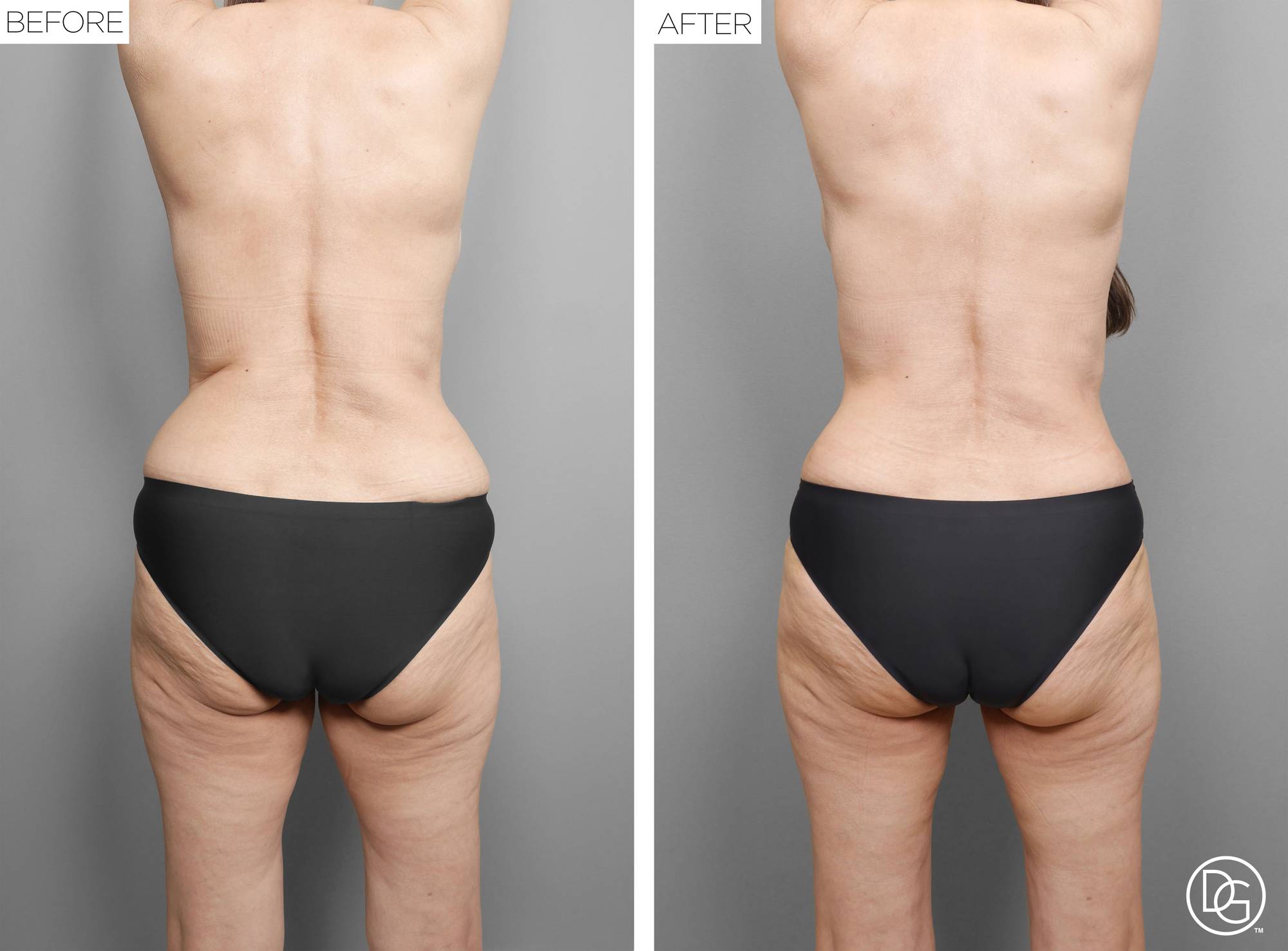  Tummy Tuck Before & After Image