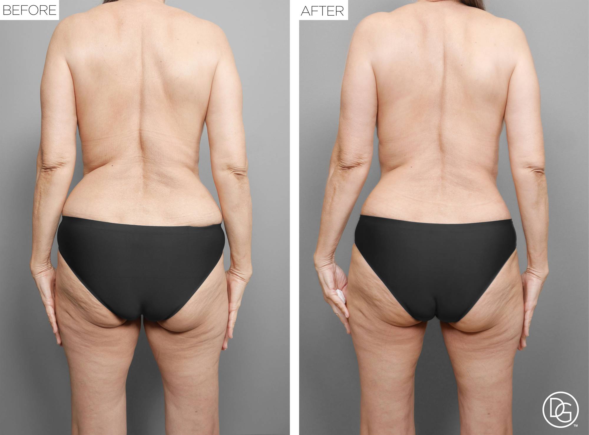  Tummy Tuck Before & After Image