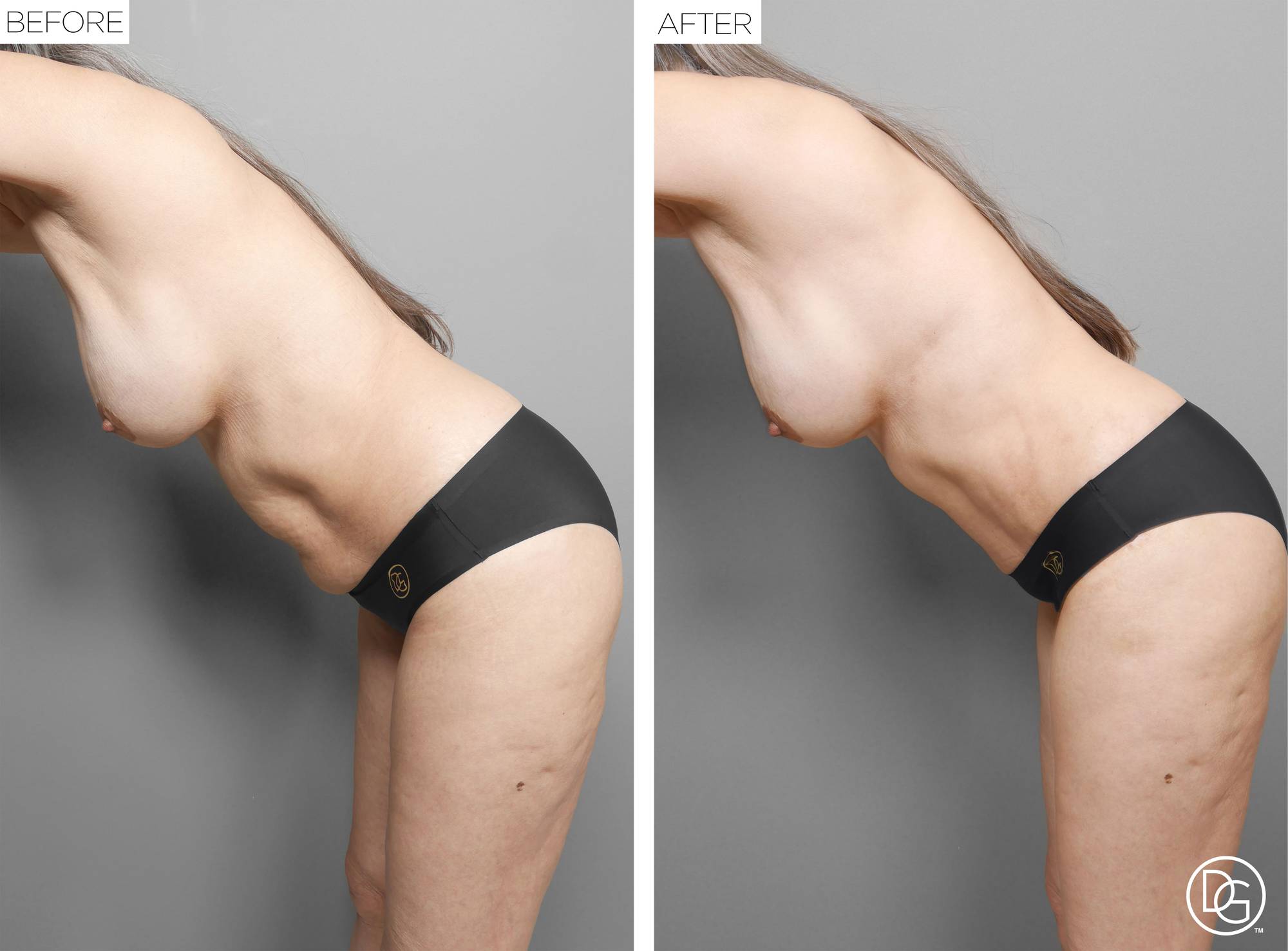  Tummy Tuck Before & After Image