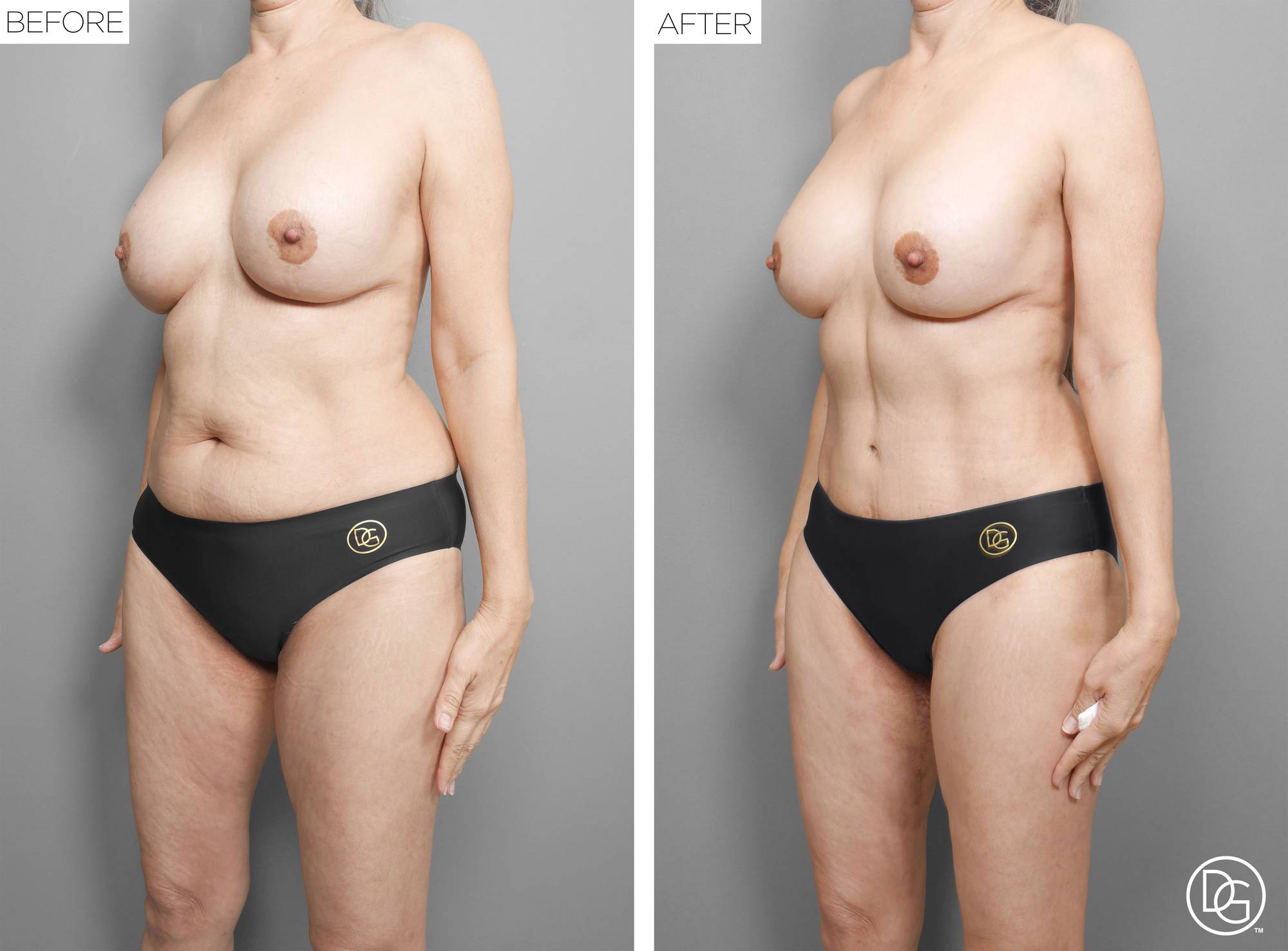  Tummy Tuck Before & After Image