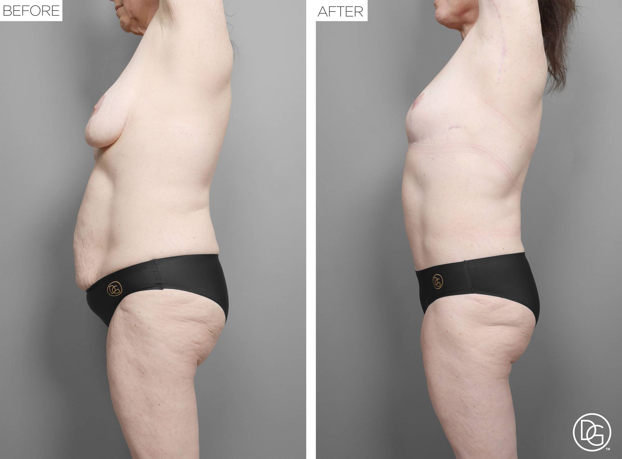 Mommy Makeover Before & After Image