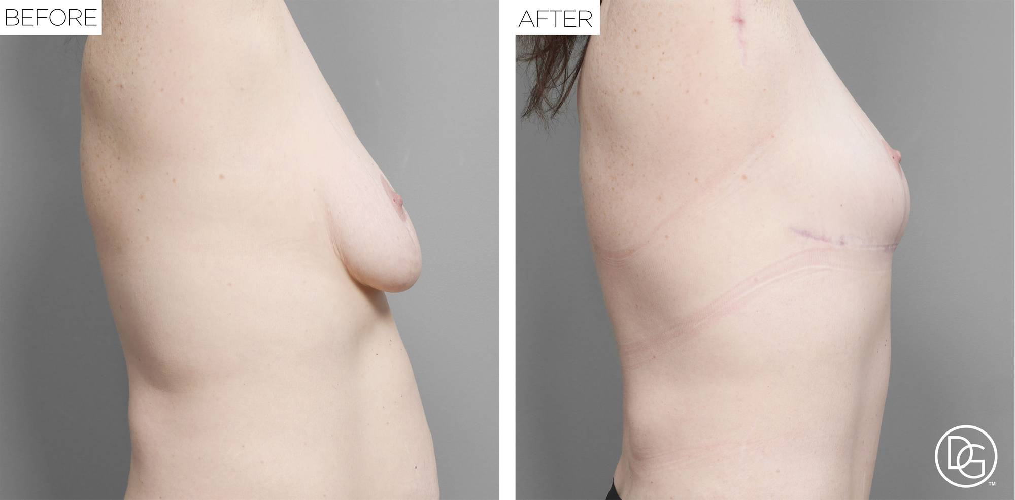 Breast Revision Before & After Image