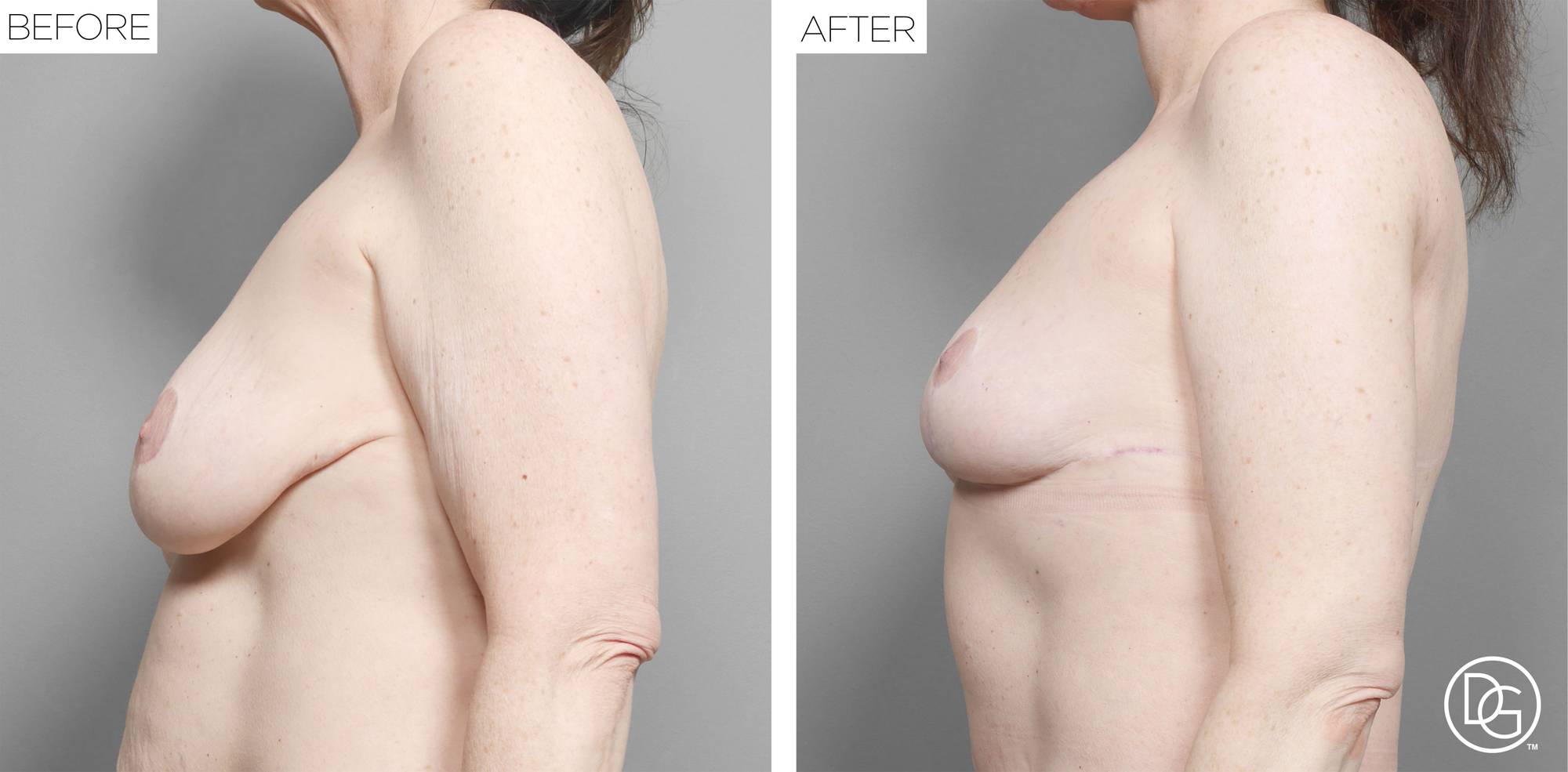 Breast Revision Before & After Image