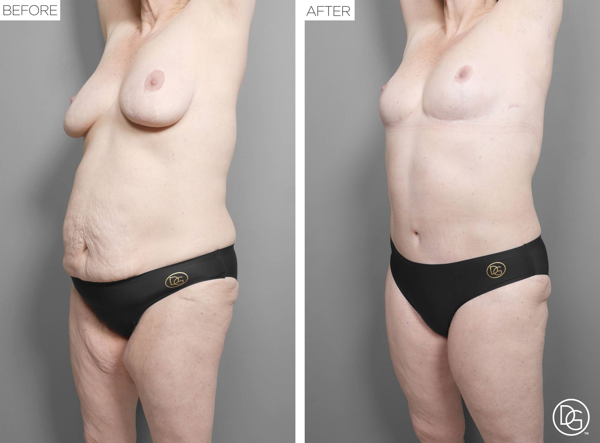 Mommy Makeover Before & After Image