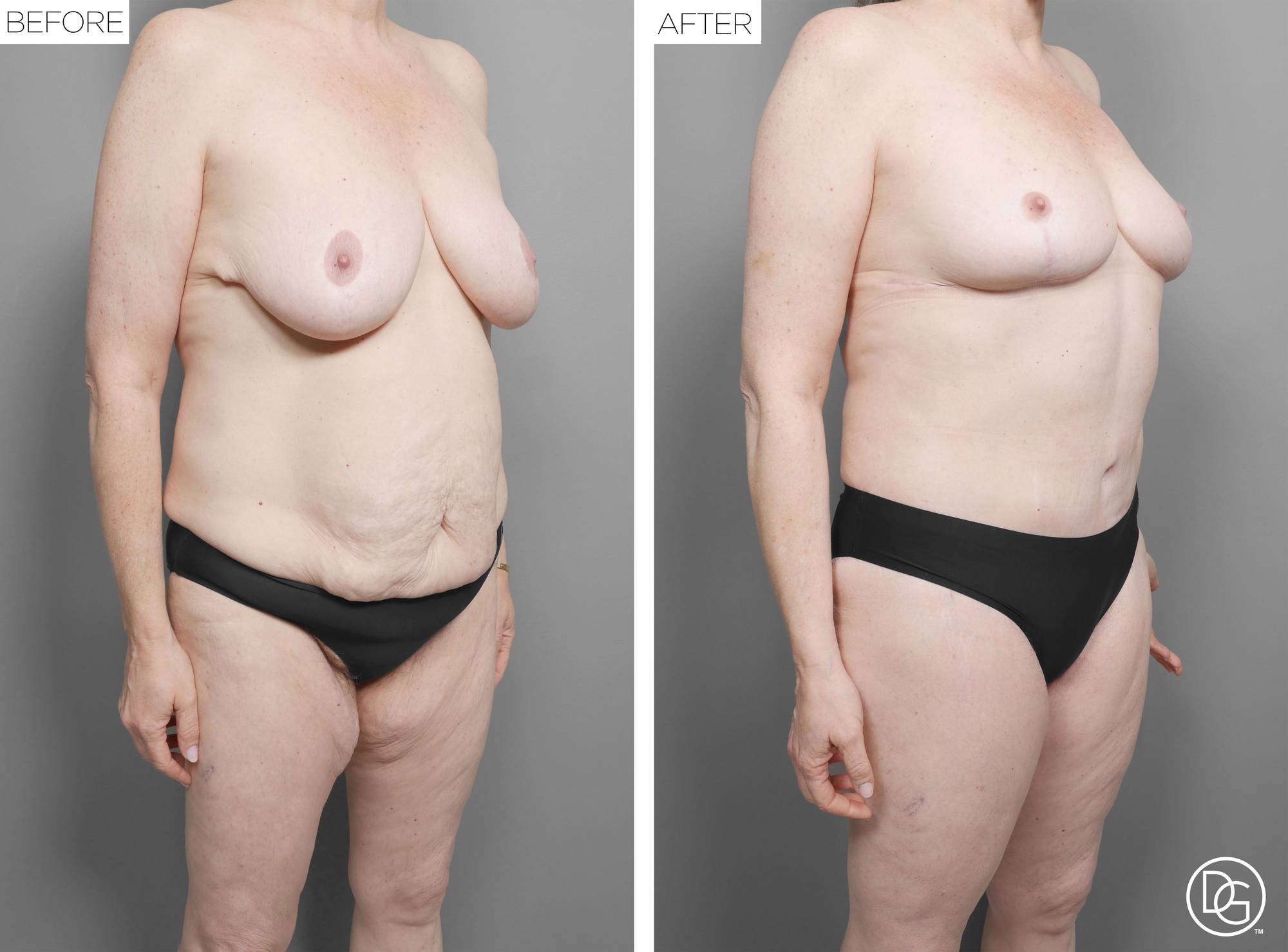 Mommy Makeover Before & After Image