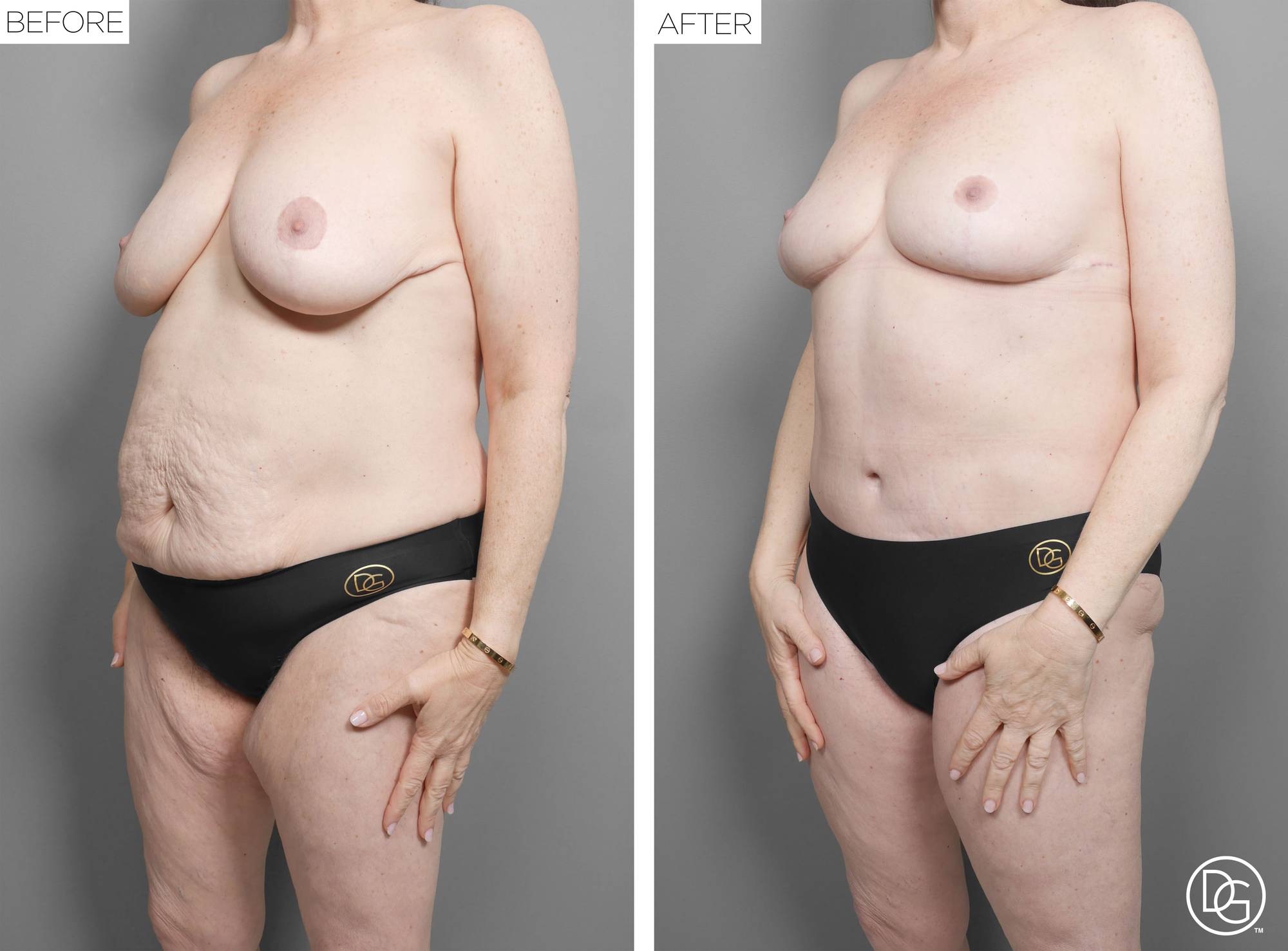 Mommy Makeover Before & After Image
