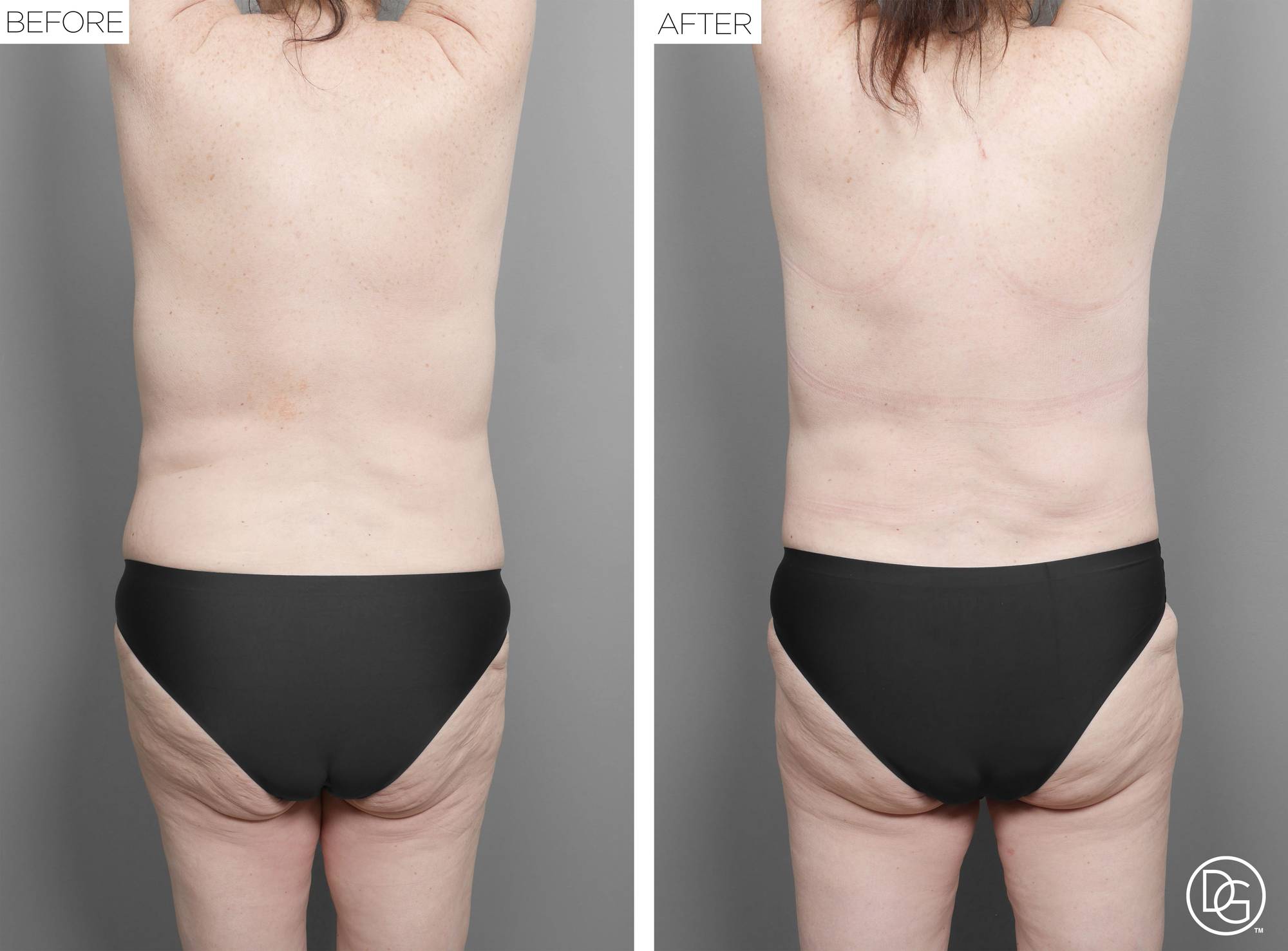 Mommy Makeover Before & After Image