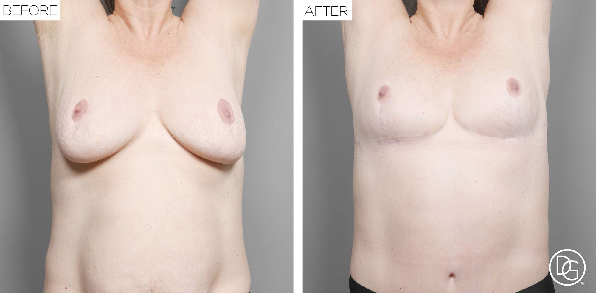 Breast Revision Before & After Image