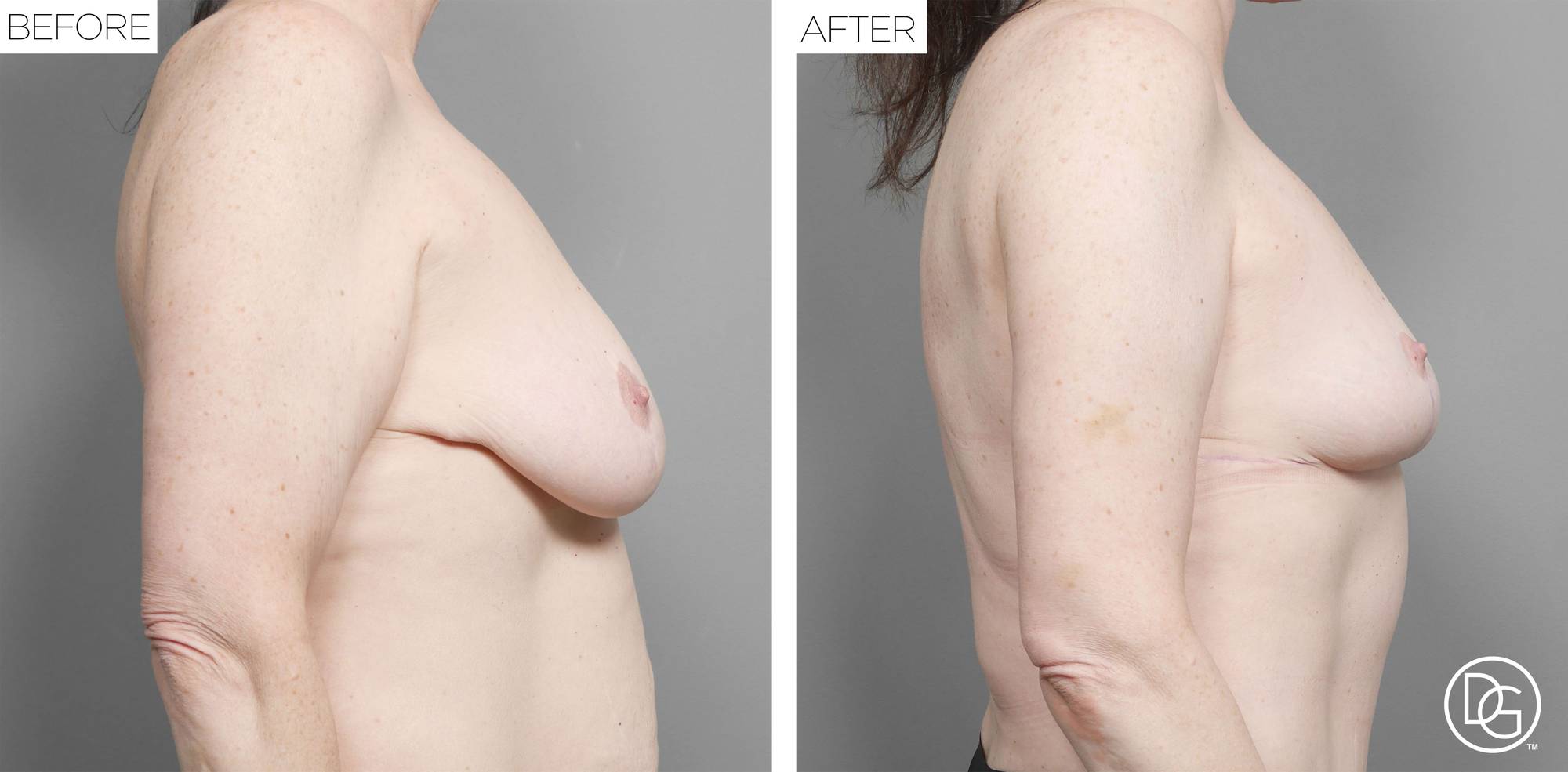 Breast Revision Before & After Image