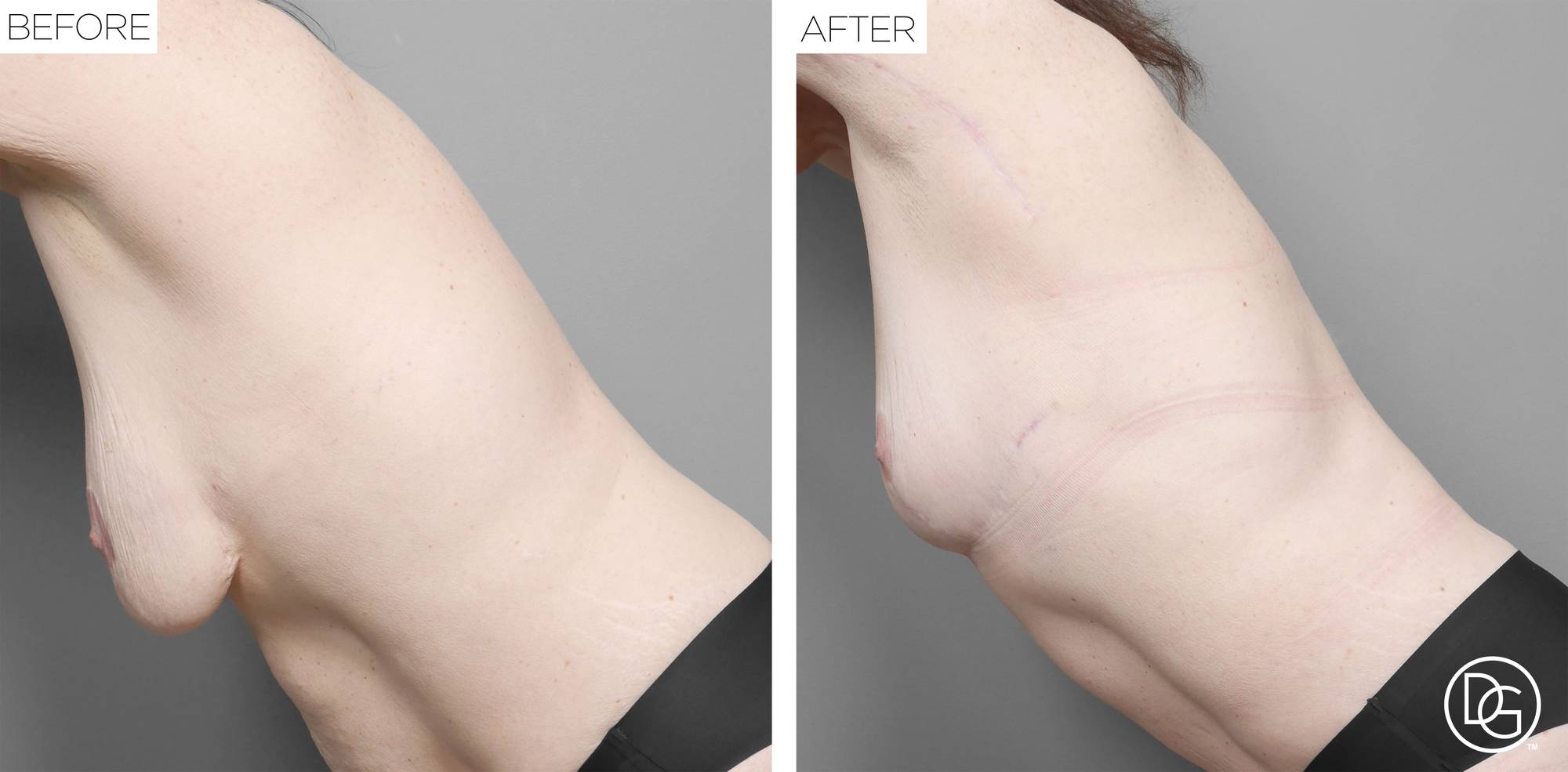 Breast Revision Before & After Image