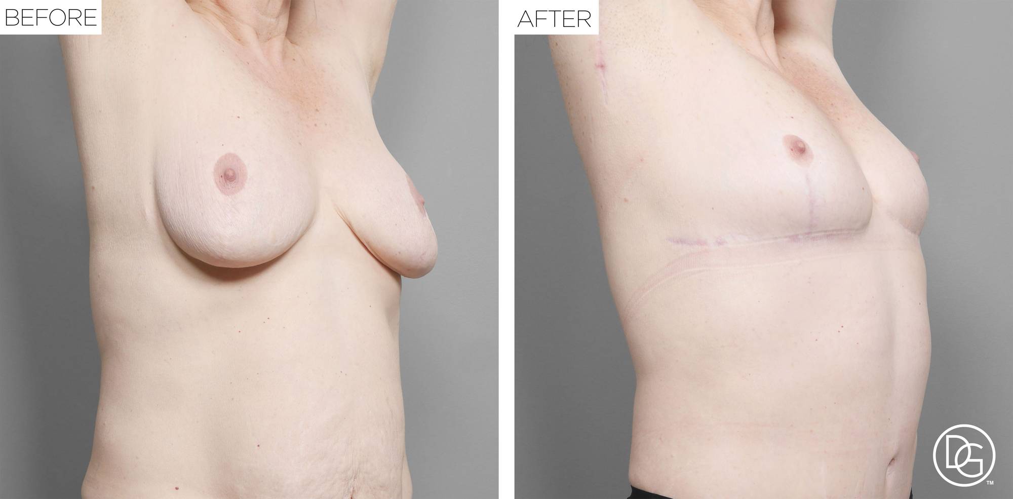 Breast Revision Before & After Image